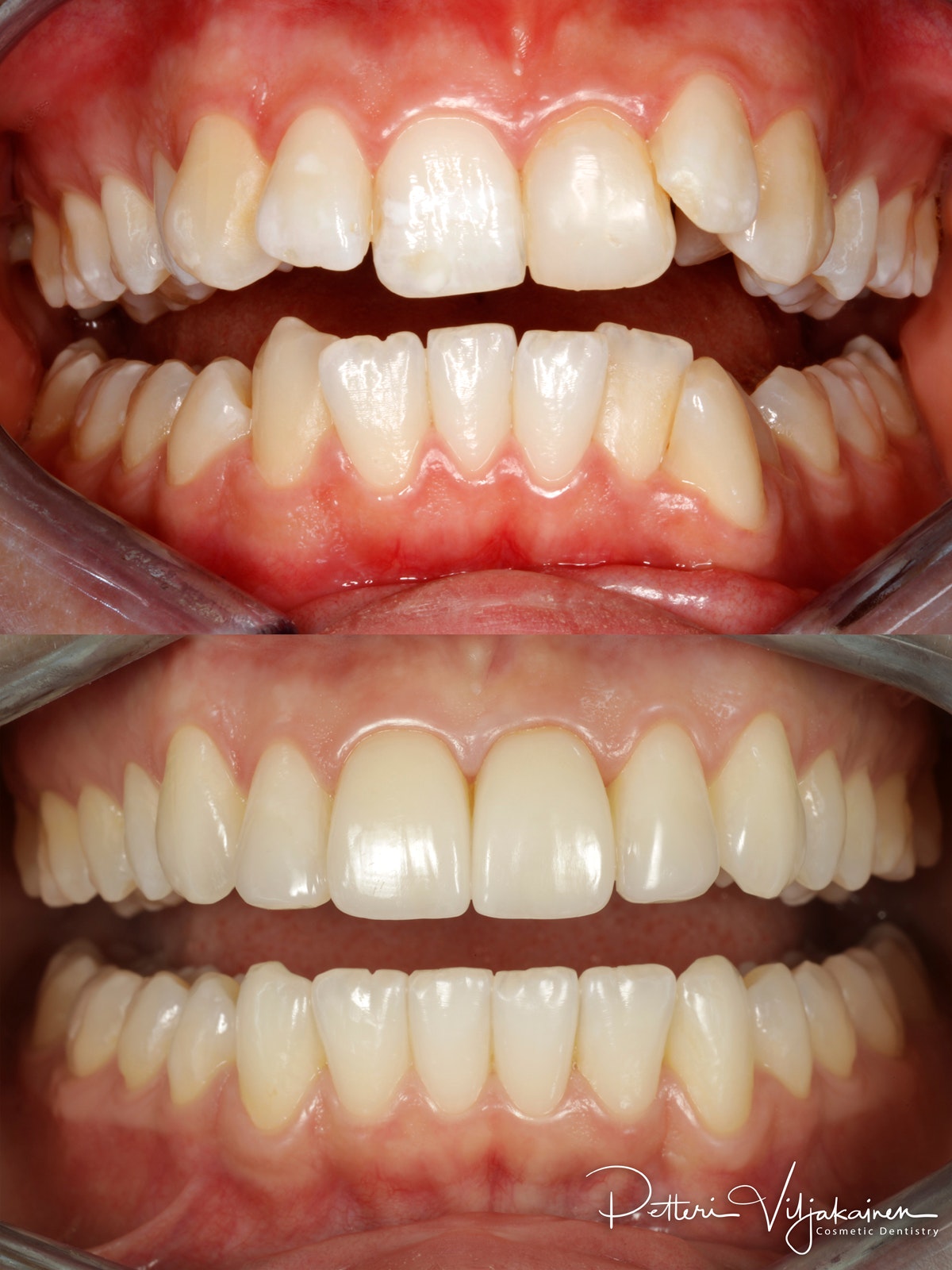 invisalign oikomishoito hampaat ennen jälkeen keraamiset kuoret