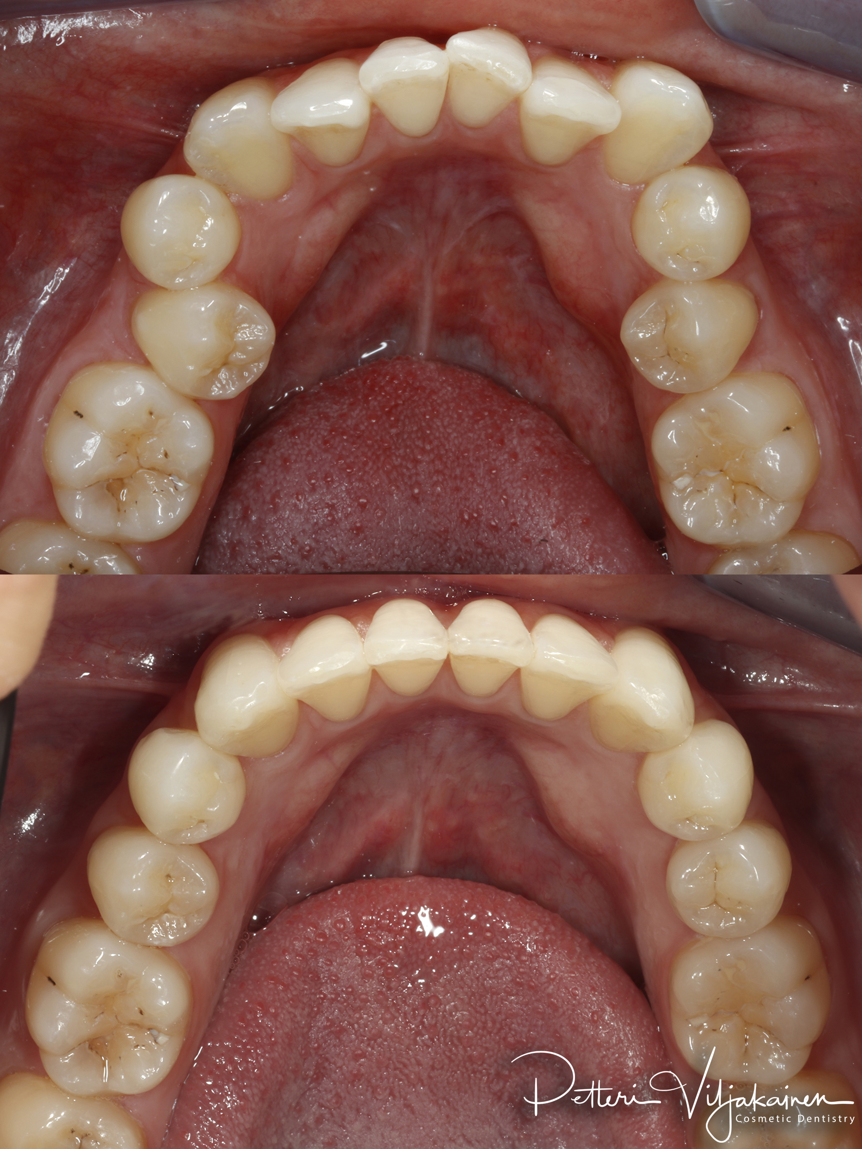 Oikomishoito ennen/jälkeen.