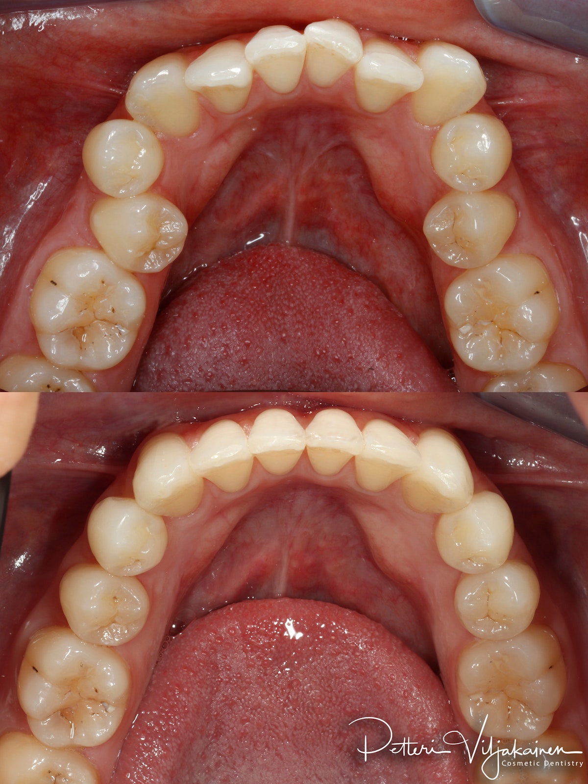 Oikomishoito ennen/jälkeen.