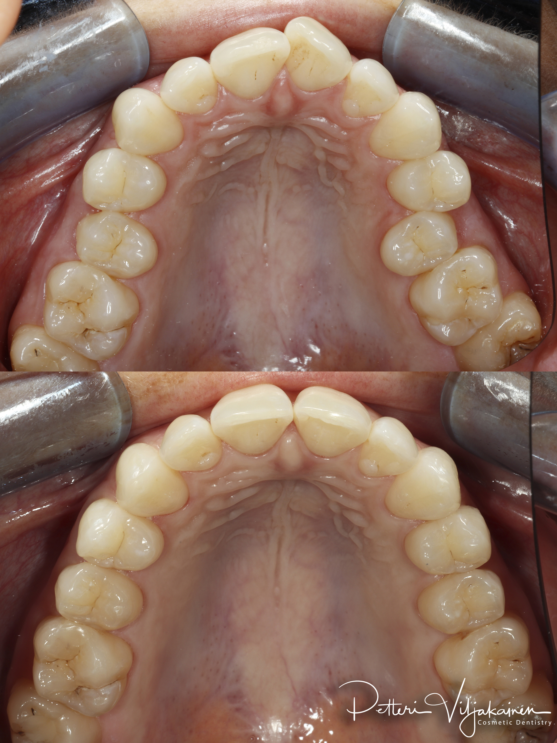 Oikomishoito ennen/jälkeen.