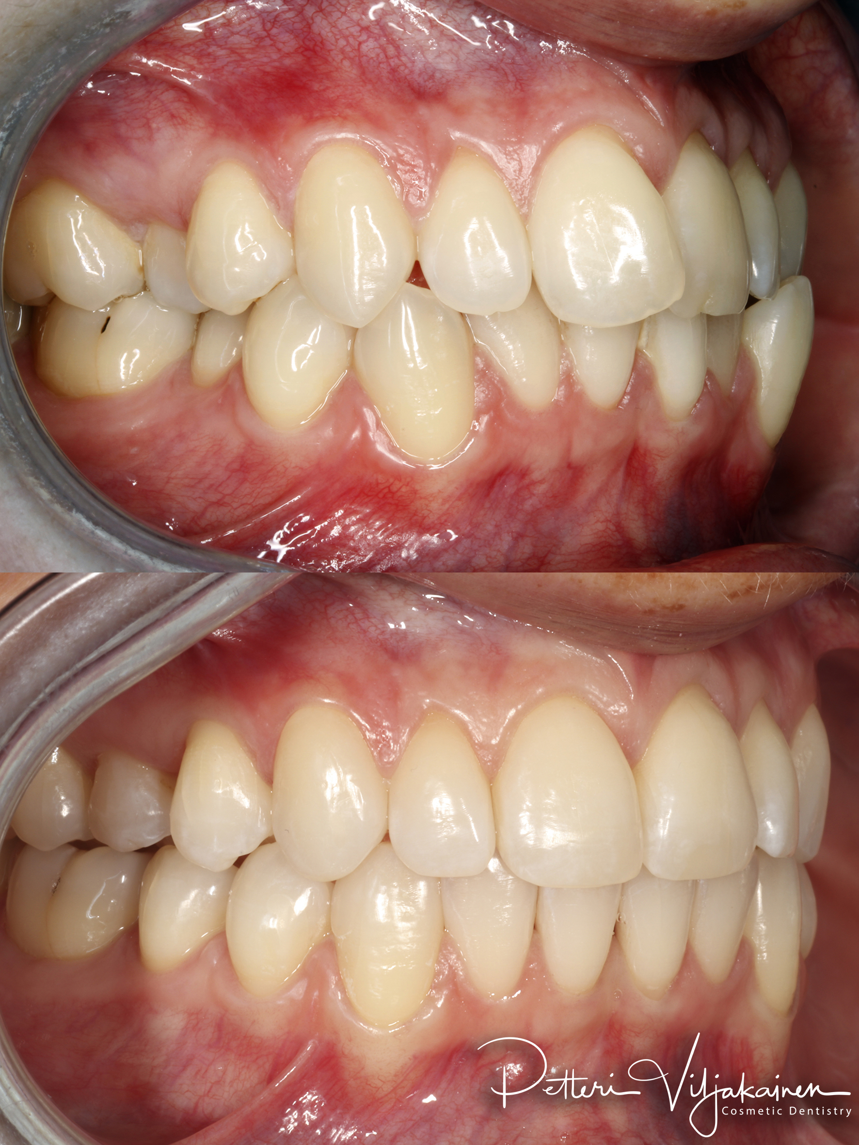 invisalign oikomishoito hampaat ennen jälkeen