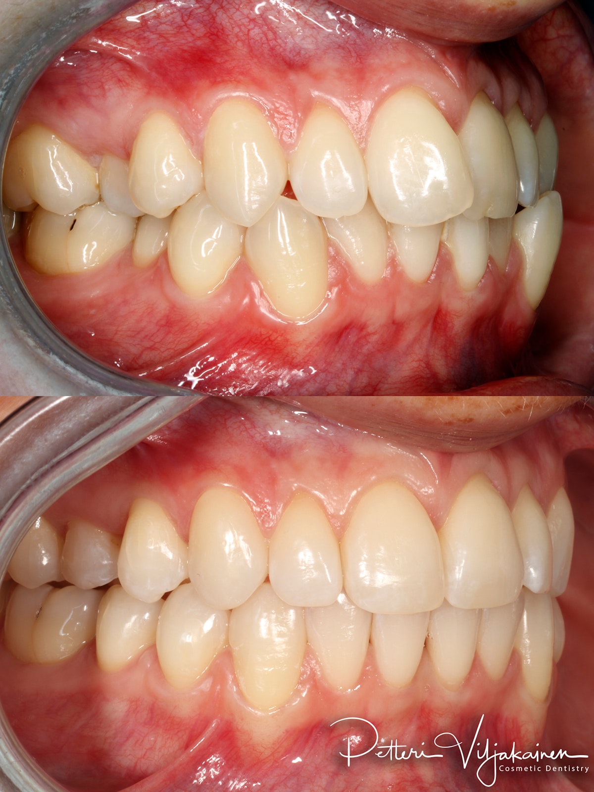 invisalign oikomishoito hampaat ennen jälkeen