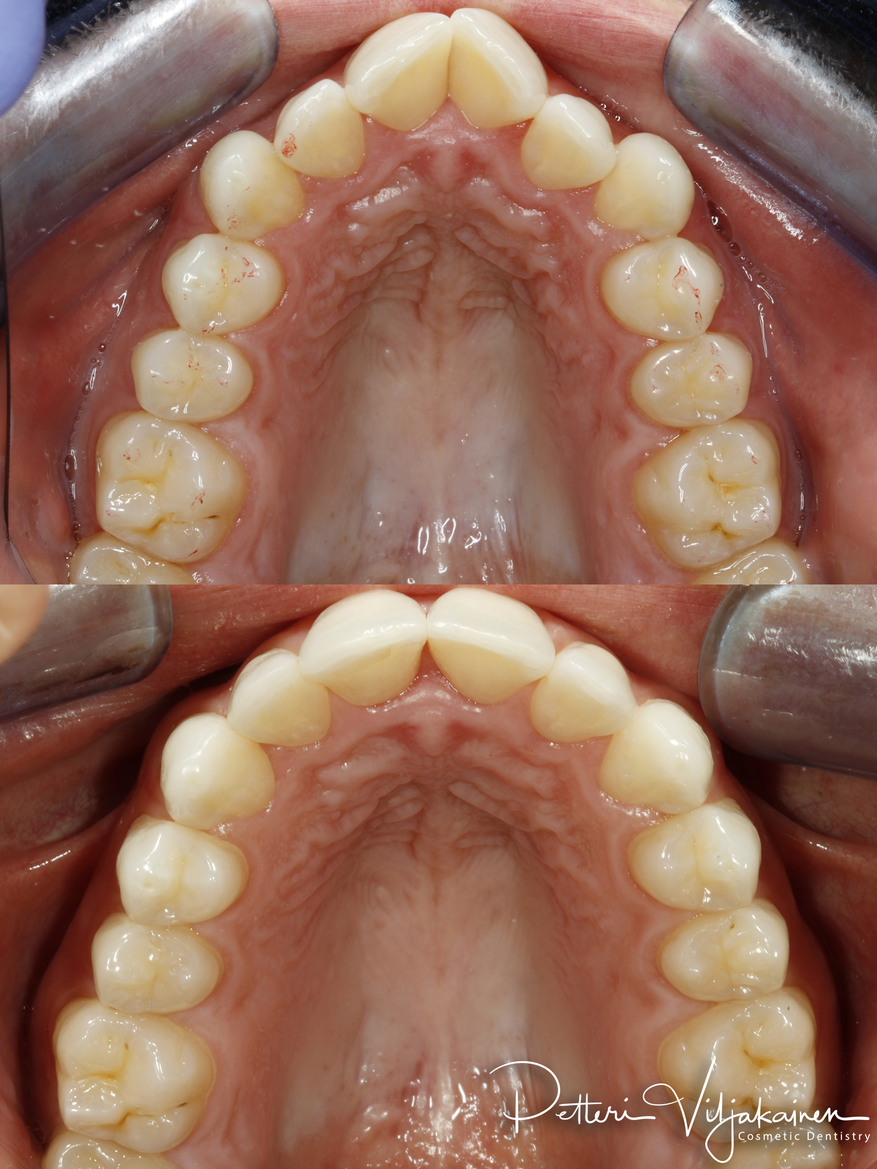 Invisalign oikomishoito ennen/jälkeen.