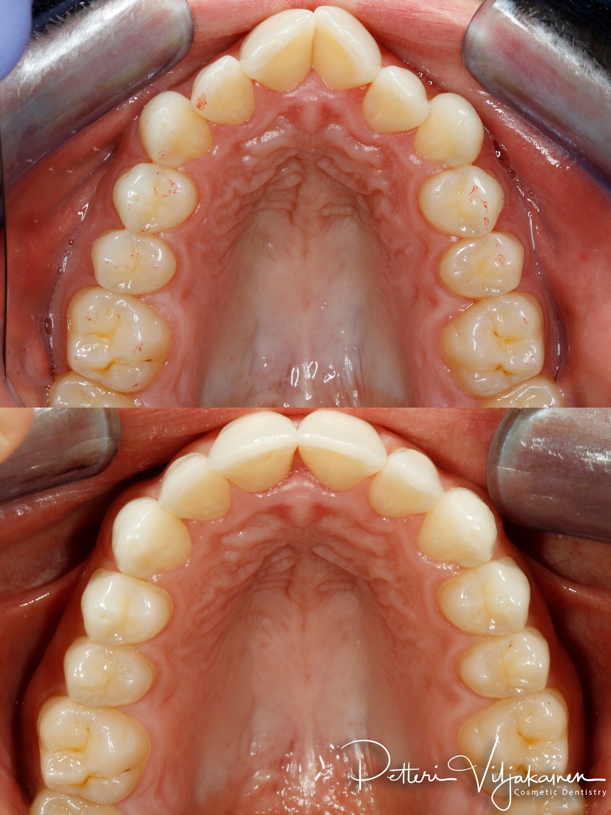Invisalign oikomishoito ennen/jälkeen.