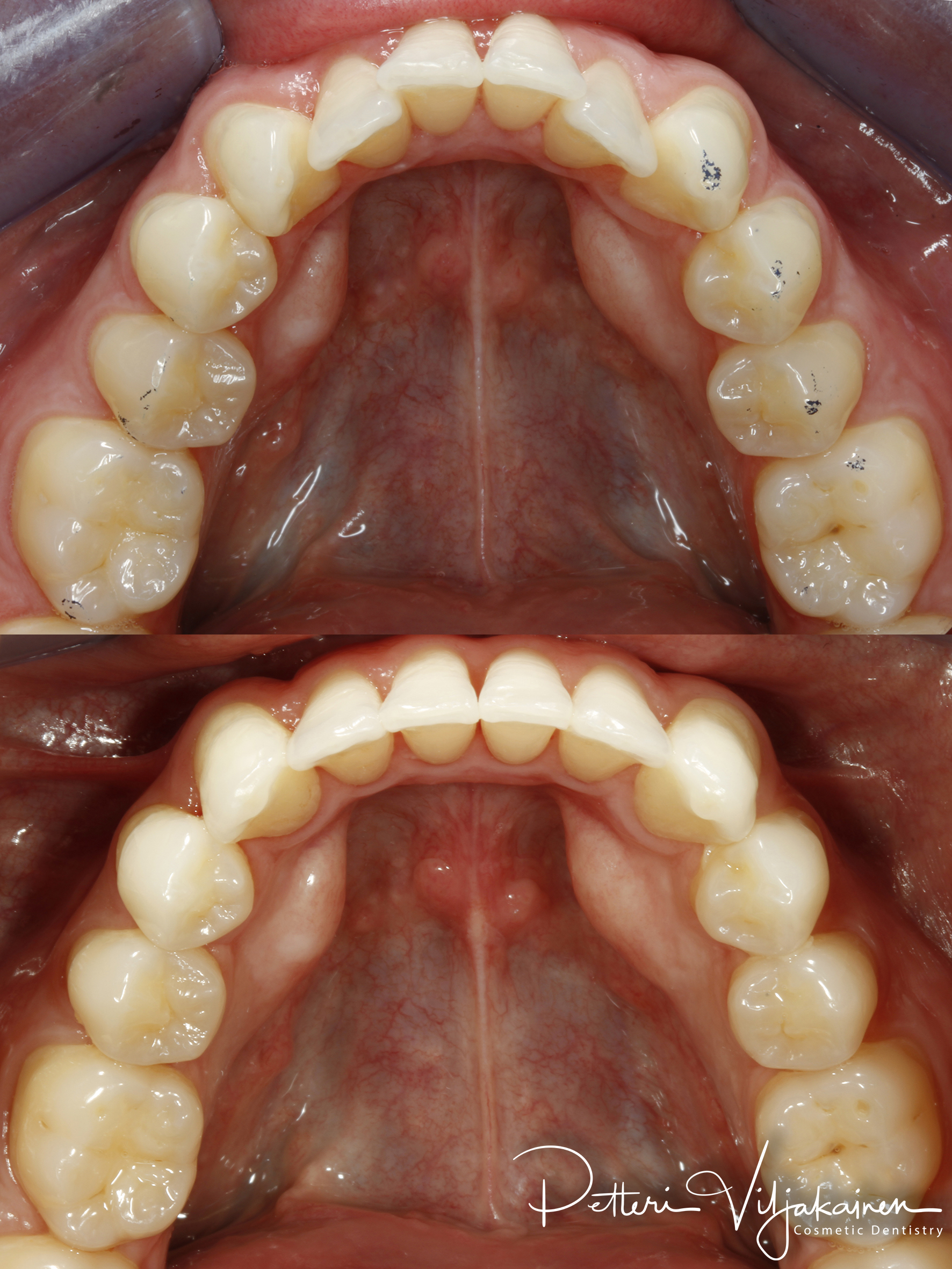 Invisalign oikomishoito ennen/jälkeen.