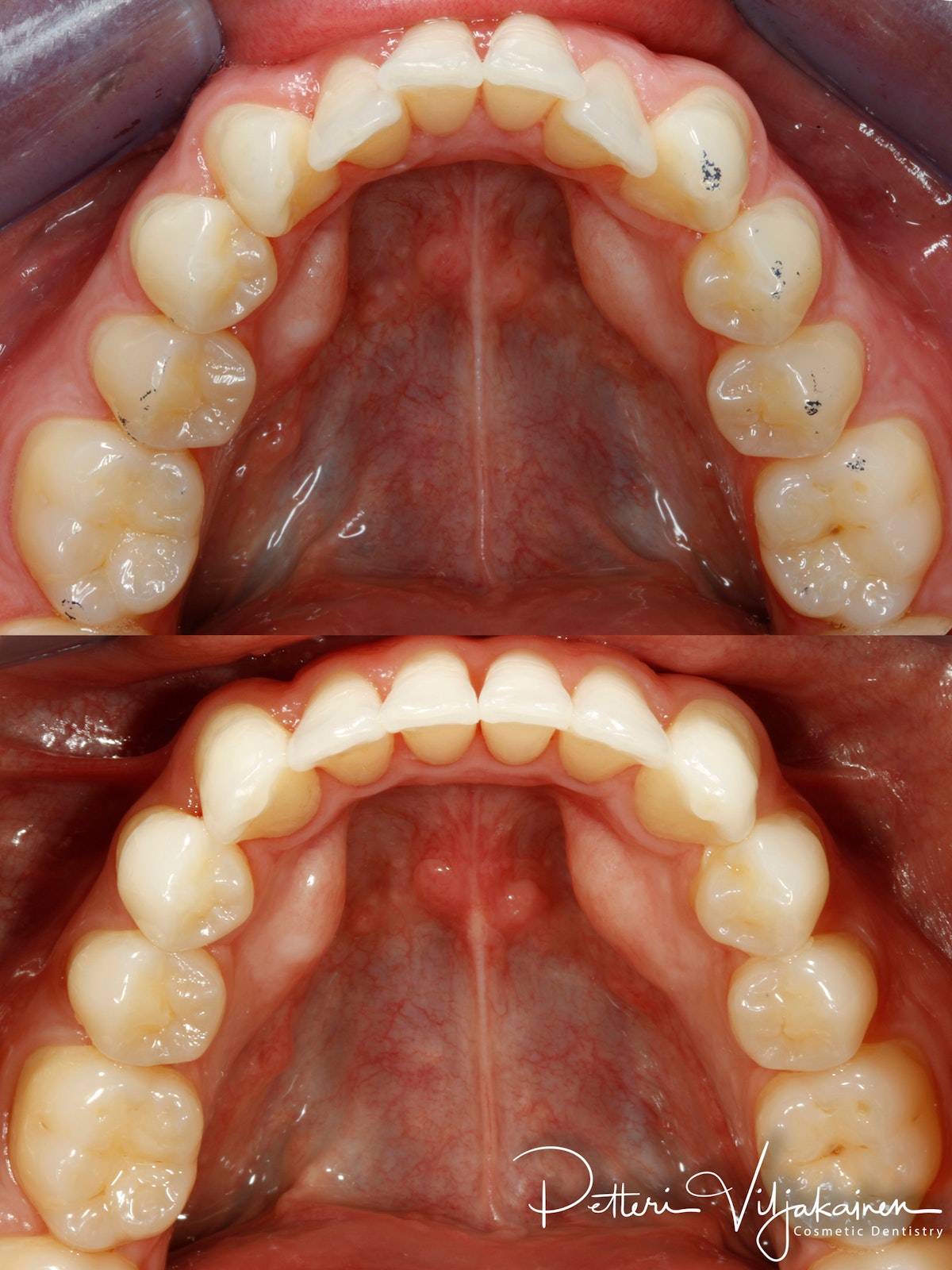 Invisalign oikomishoito ennen/jälkeen.