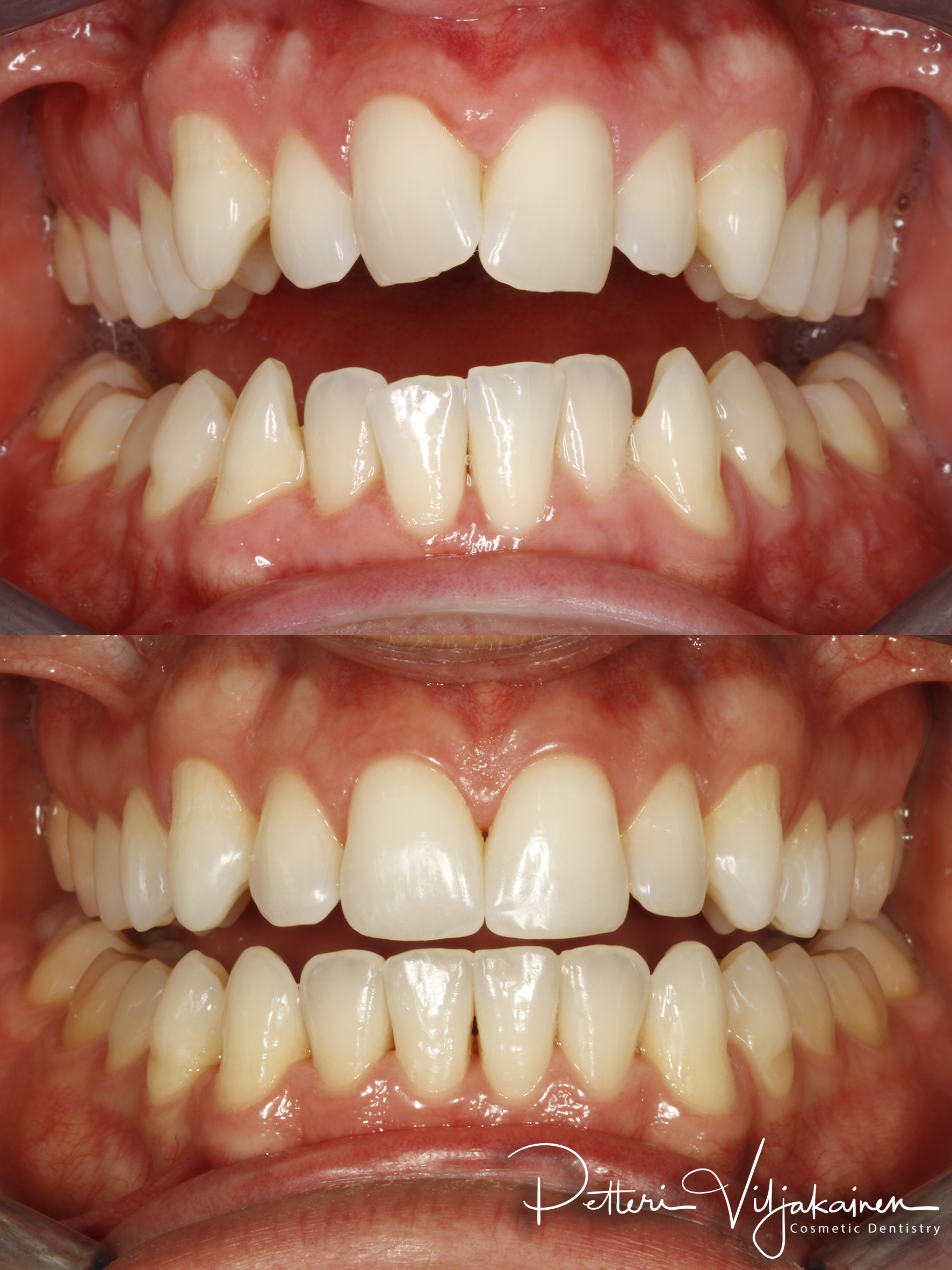 invisalign oikomishoito hampaat ennen jälkeen keraamiset kuoret