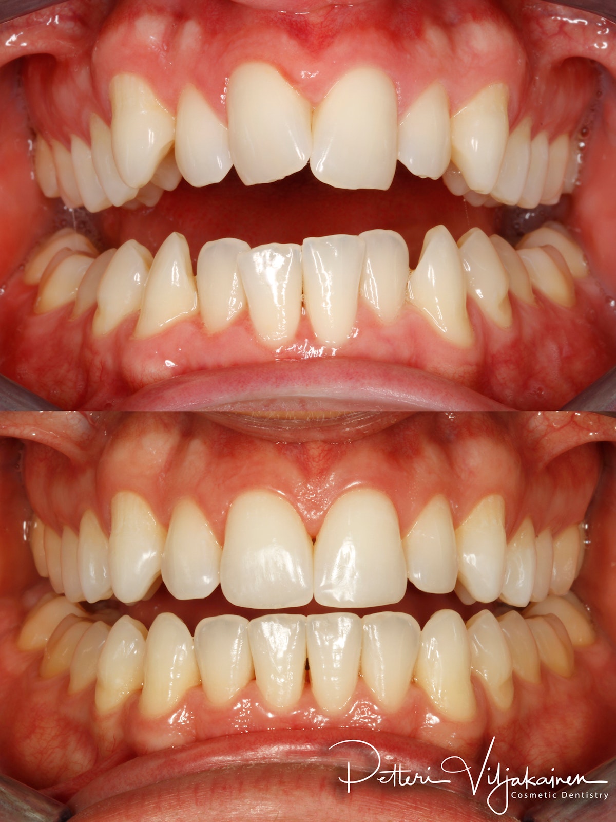 invisalign oikomishoito hampaat ennen jälkeen keraamiset kuoret