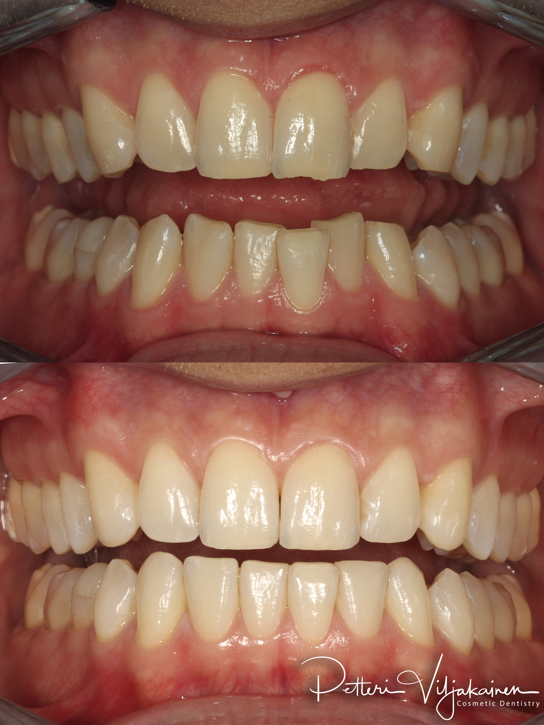 Oikomishoito ennen/jälkeen.