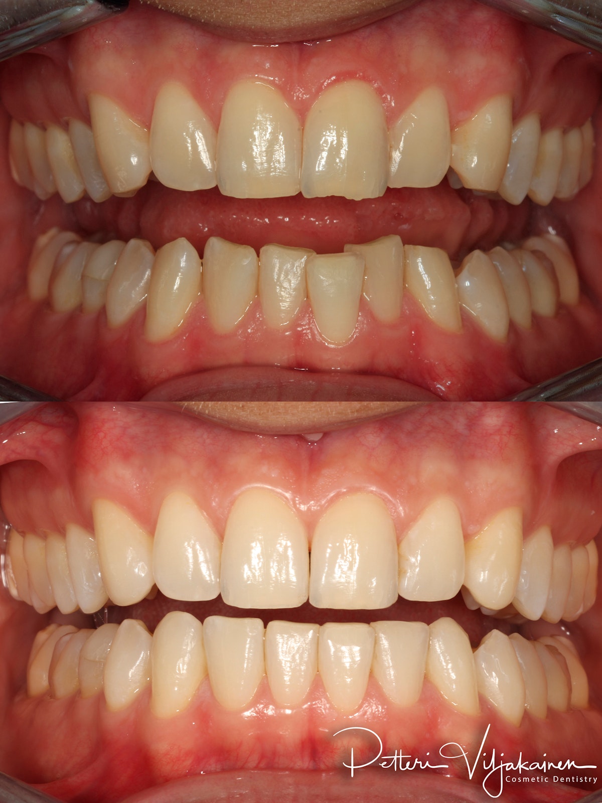 Oikomishoito ennen/jälkeen.