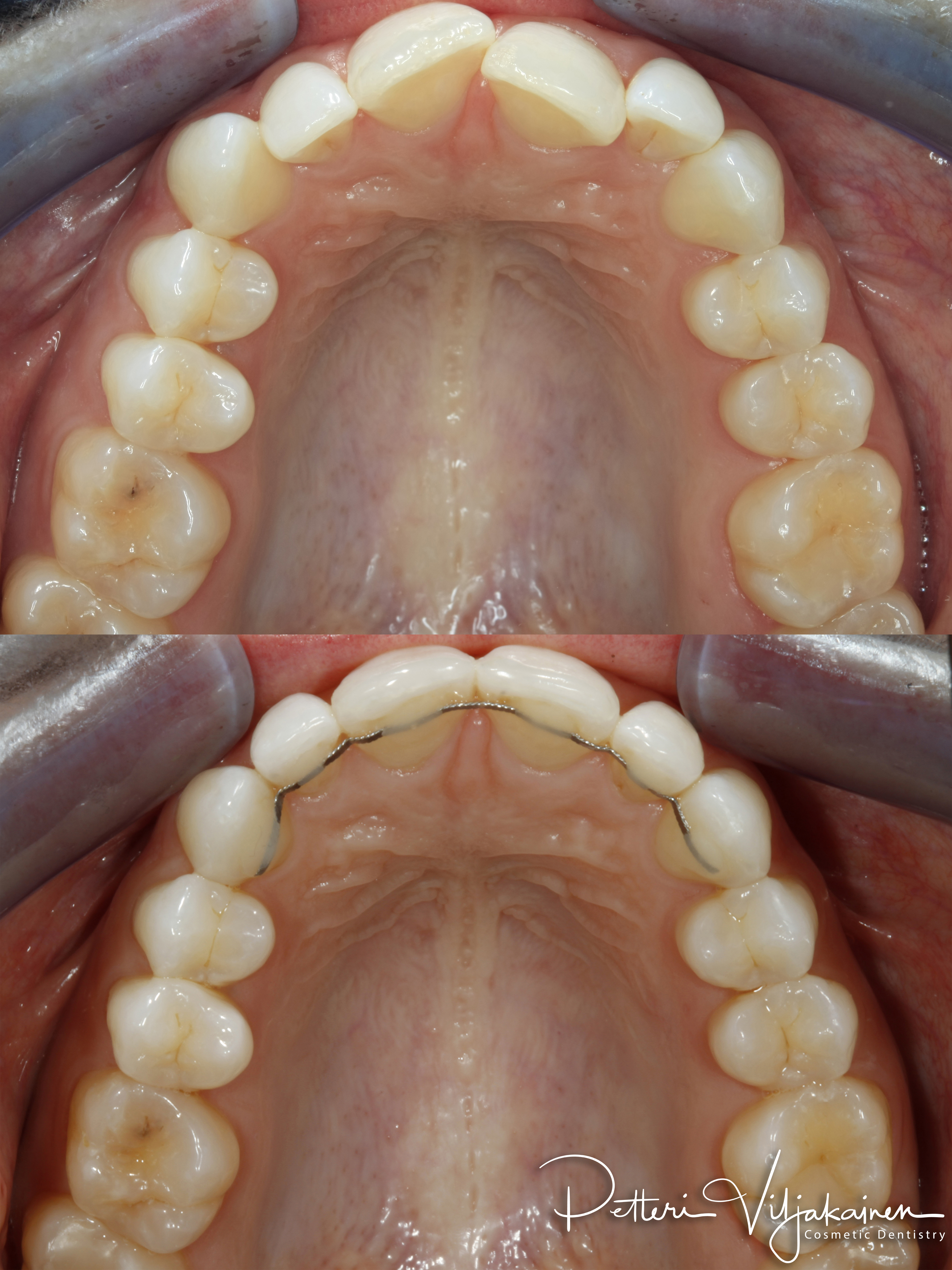 Oikomishoito ennen/jälkeen.