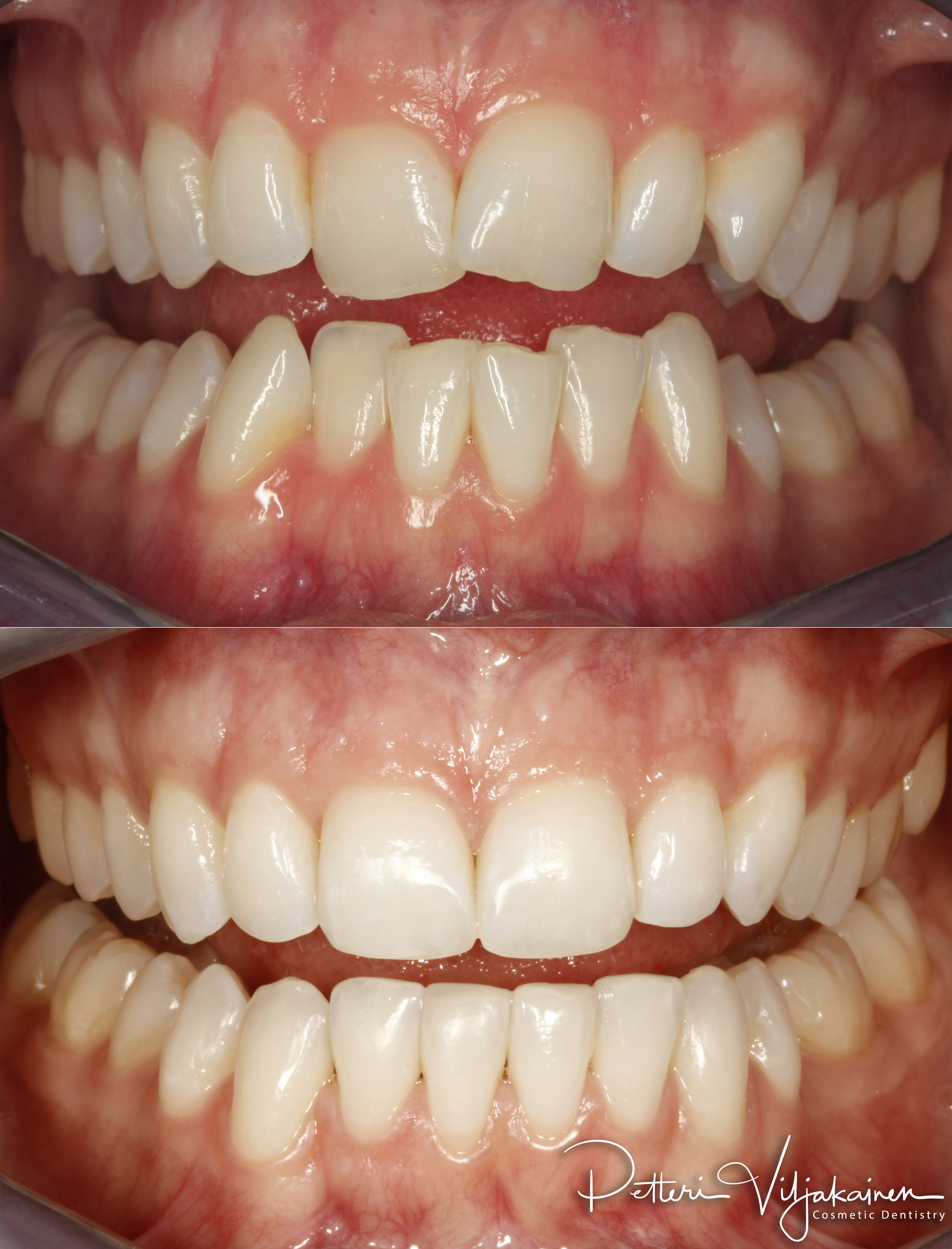 Oikomishoito ennen/jälkeen.