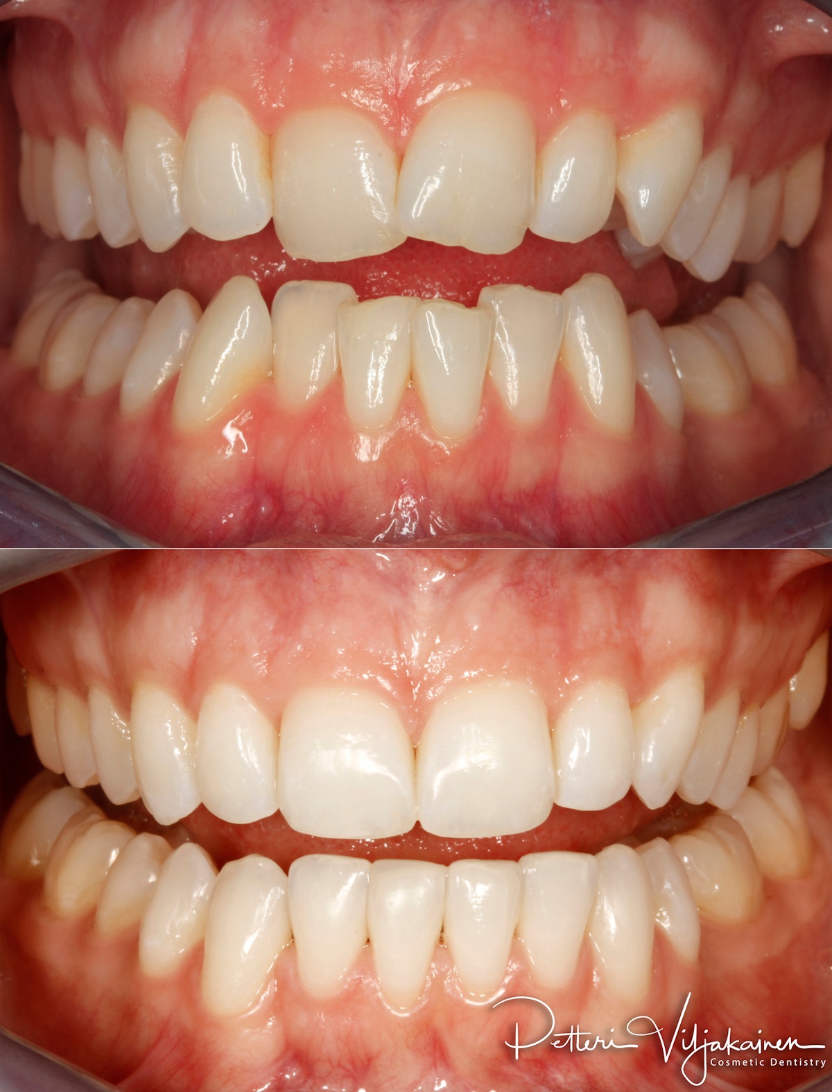 Oikomishoito ennen/jälkeen.