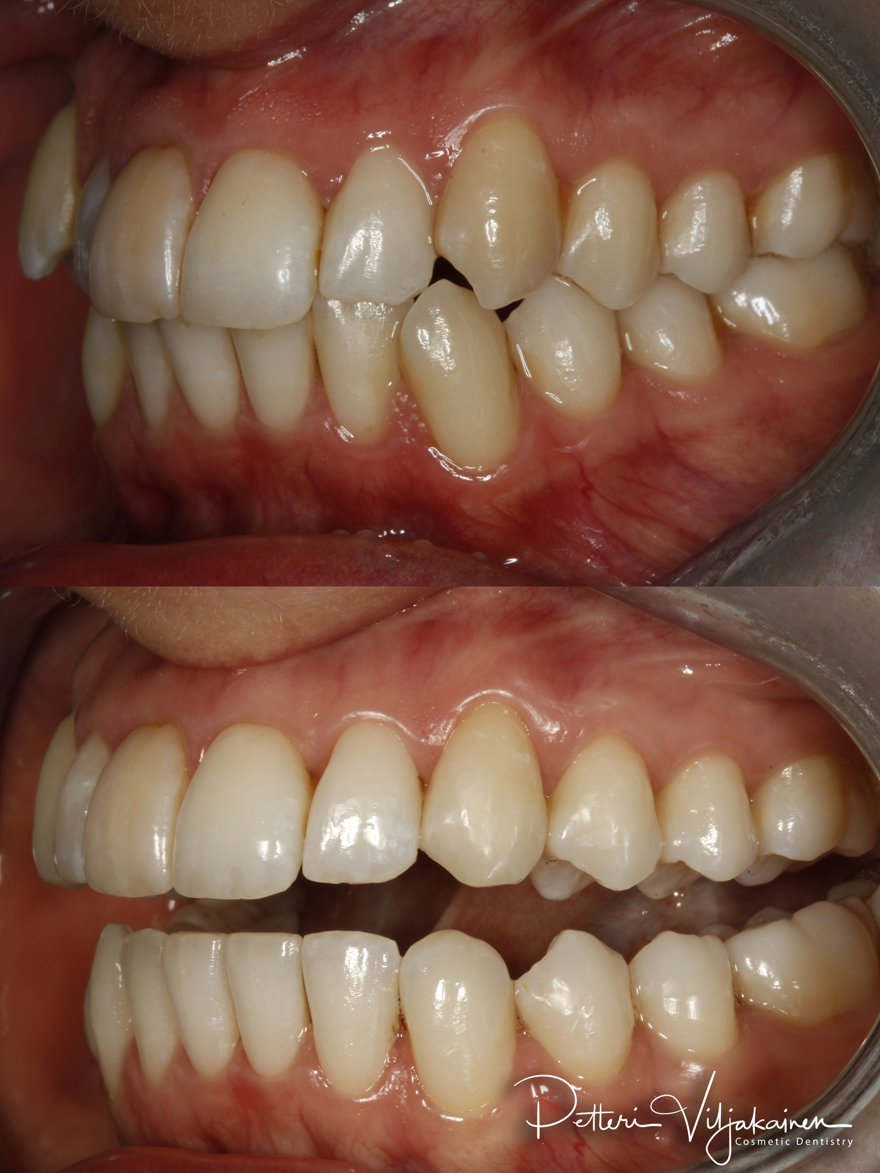 Oikomishoito ennen/jälkeen.