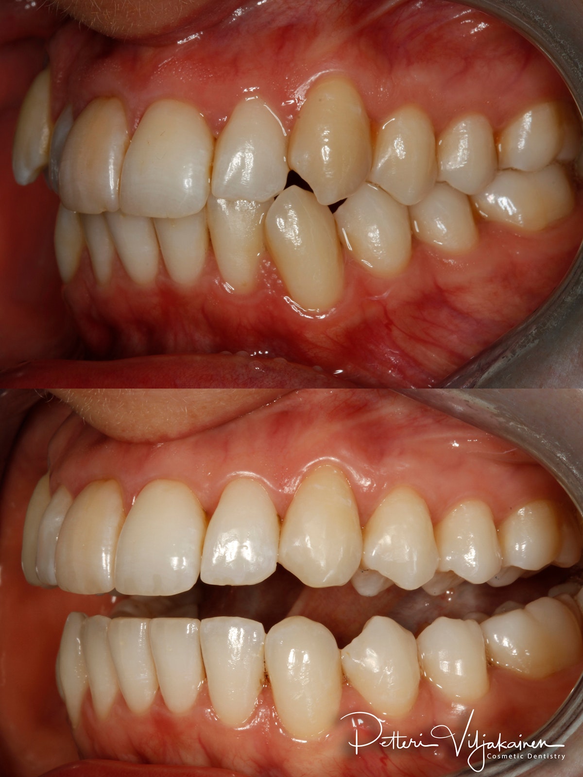 Oikomishoito ennen/jälkeen.