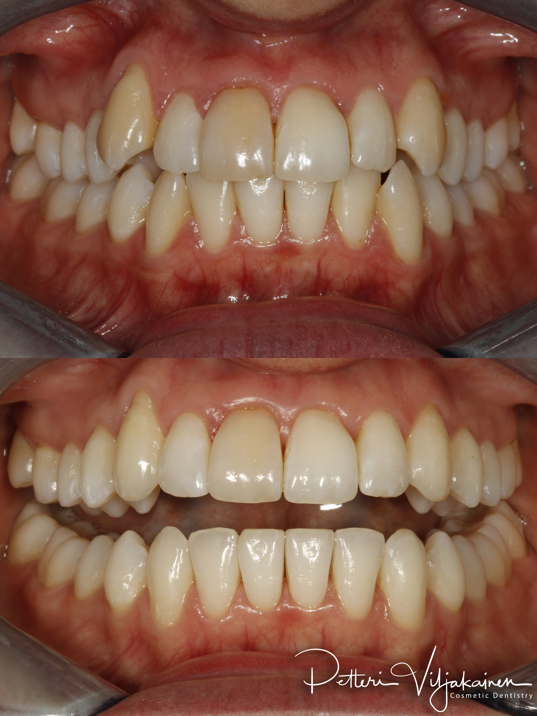 Oikomishoito ennen/jälkeen.