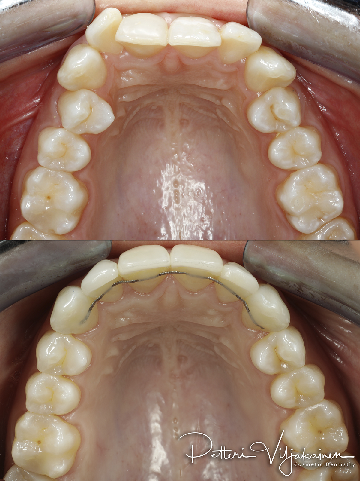 invisalign oikomishoito hampaat ennen jälkeen retentiolanka