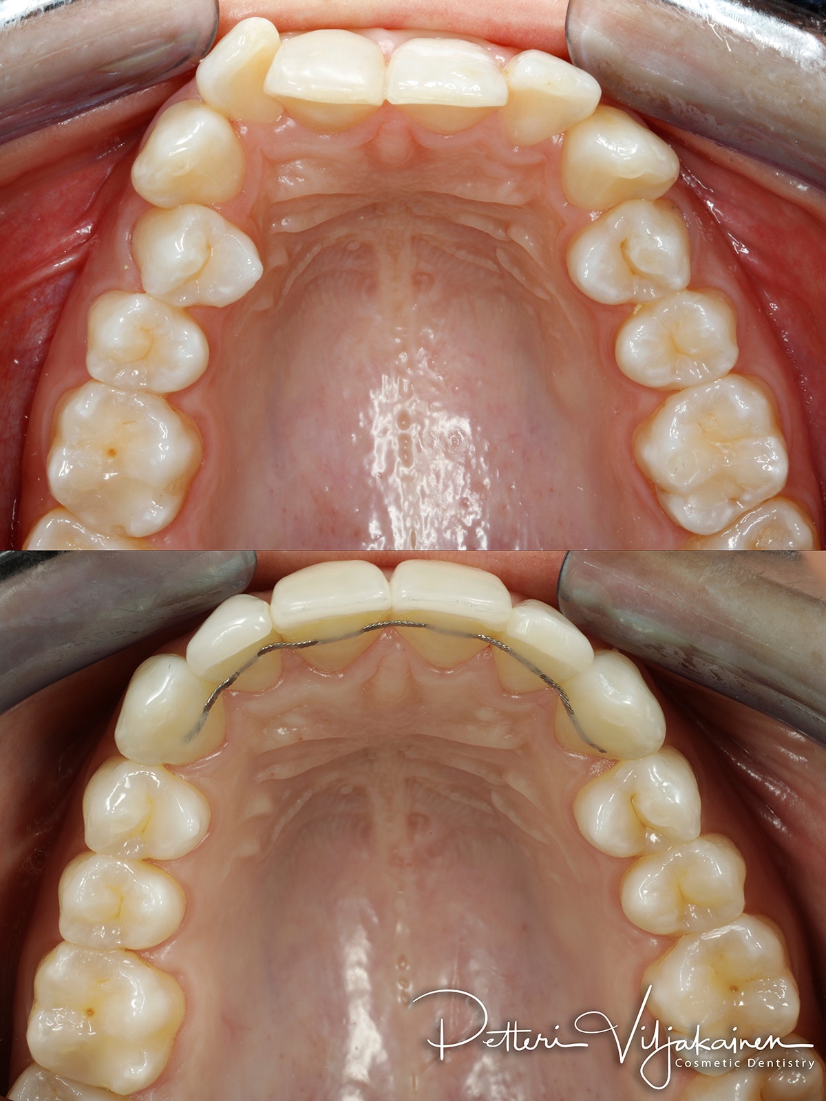 invisalign oikomishoito hampaat ennen jälkeen retentiolanka