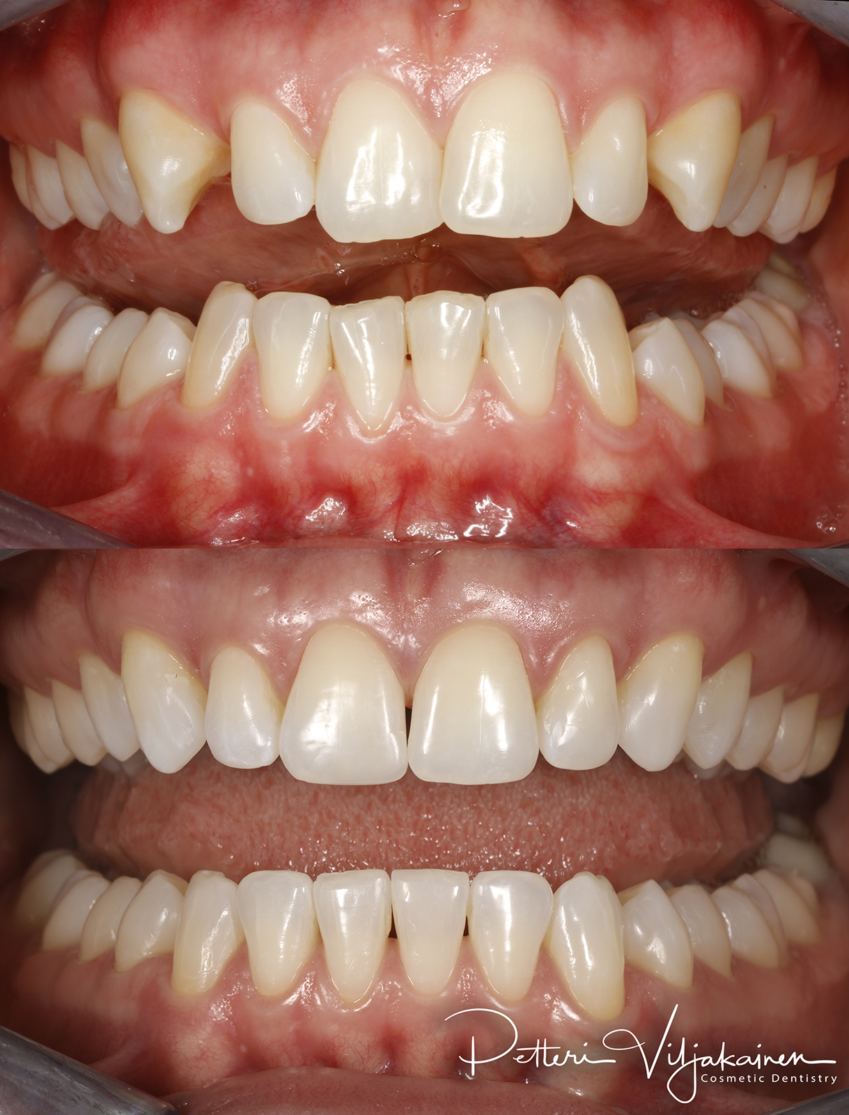 invisalign oikomishoito hampaat ennen jälkeen