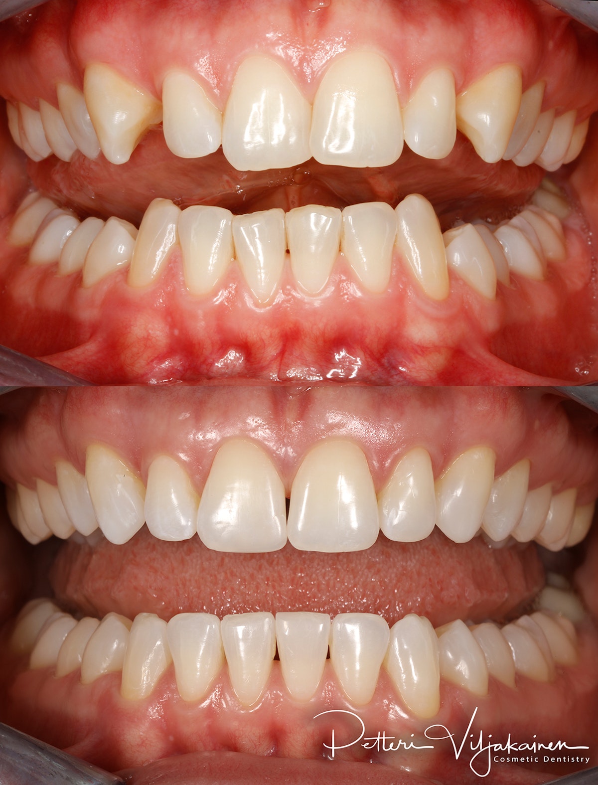 invisalign oikomishoito hampaat ennen jälkeen