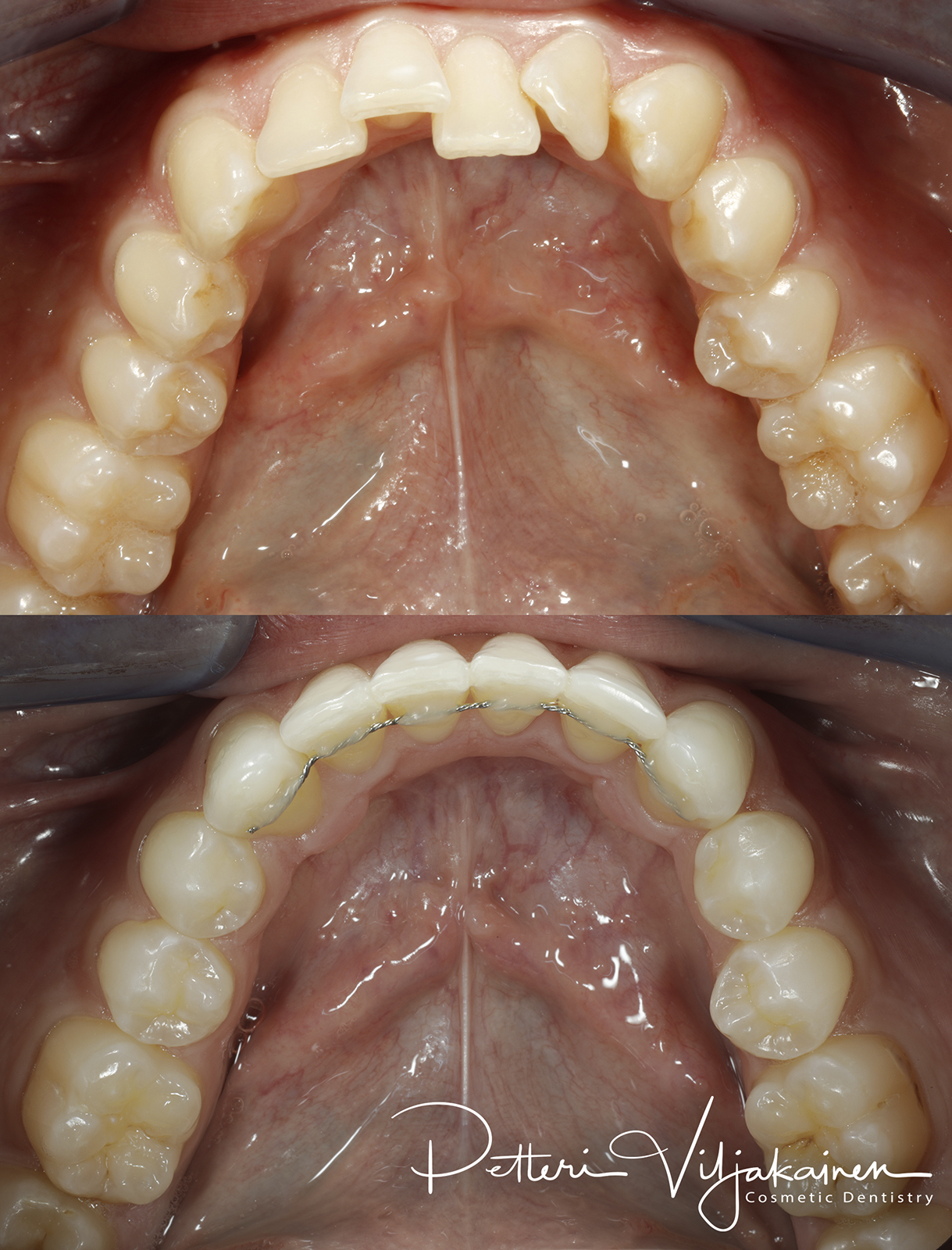 Oikomishoito ennen/jälkeen.