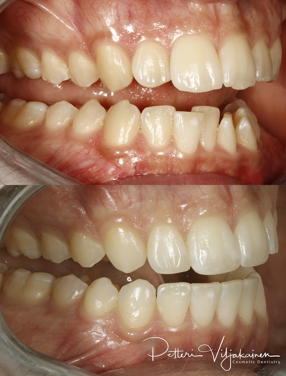 Oikomishoito ennen/jälkeen.