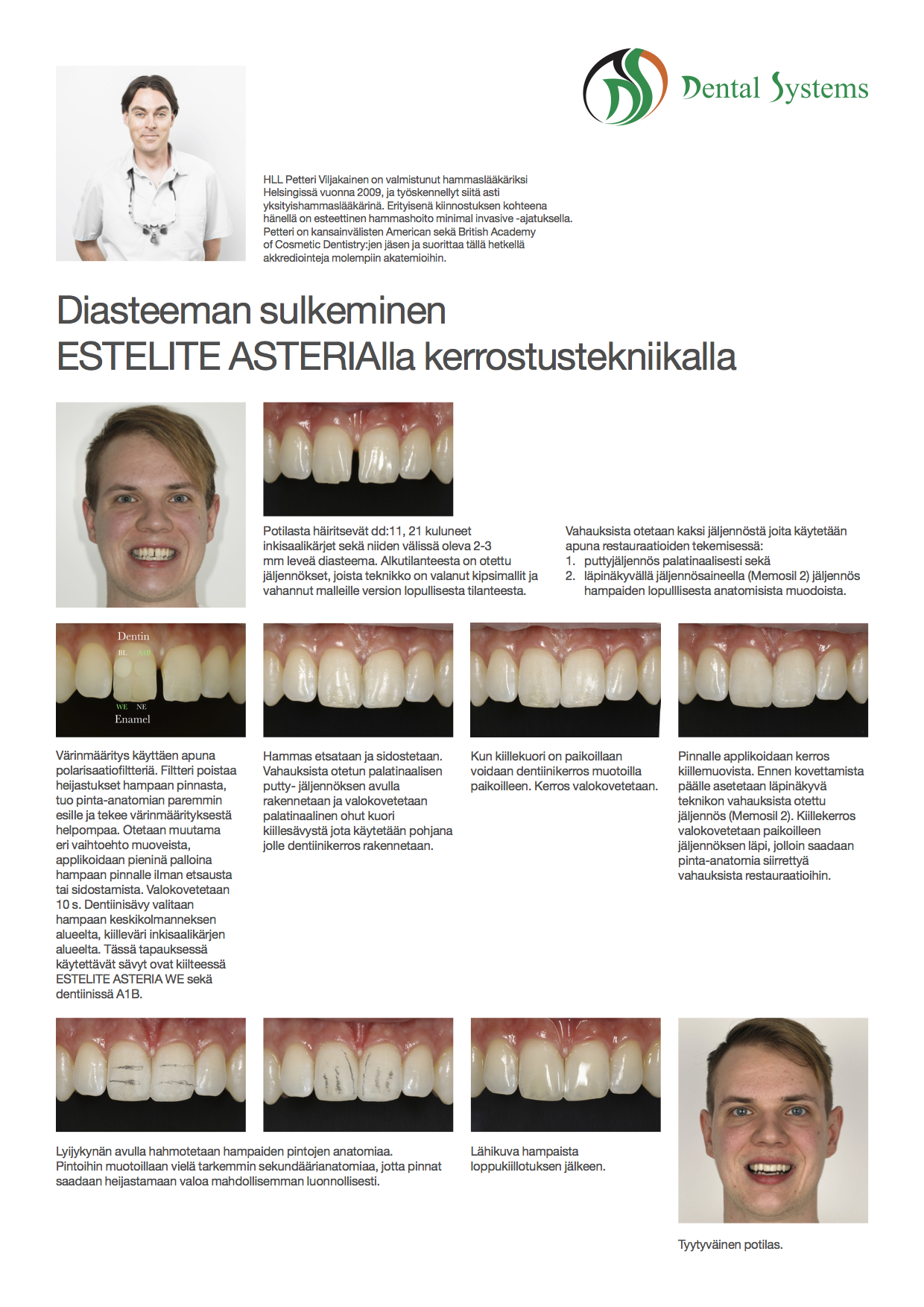 Diasteeman sulkeminen esteettisillä kerrostusmuovitäytteillä.
