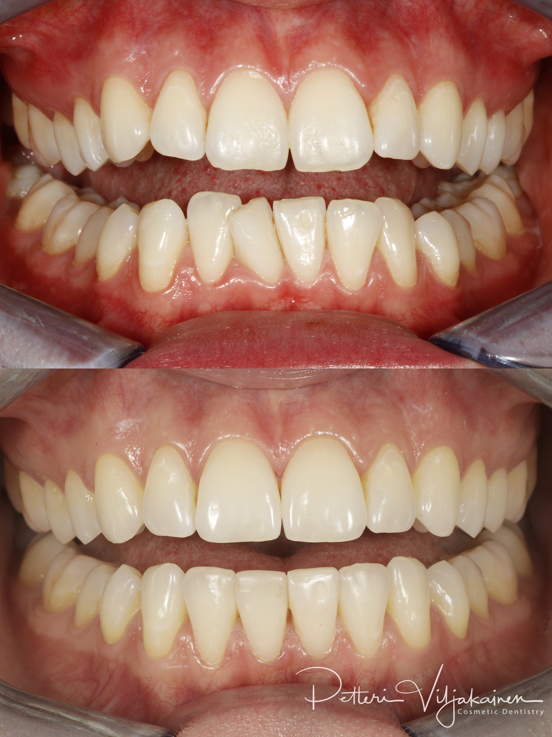 invisalign oikomishoito hampaat ennen jälkeen esteettiset kerrostusvuovit