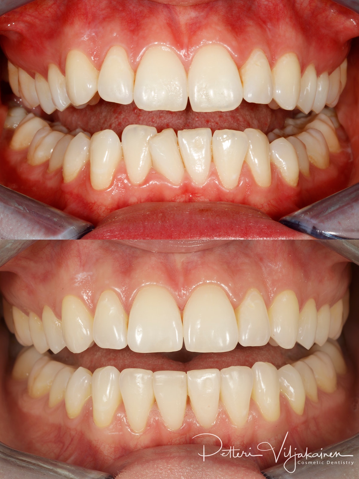 invisalign oikomishoito hampaat ennen jälkeen esteettiset kerrostusvuovit