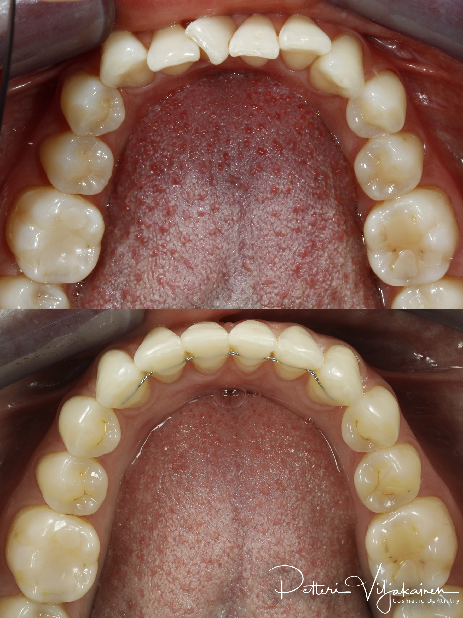 Invisalign oikomishoito ennen/jälkeen.