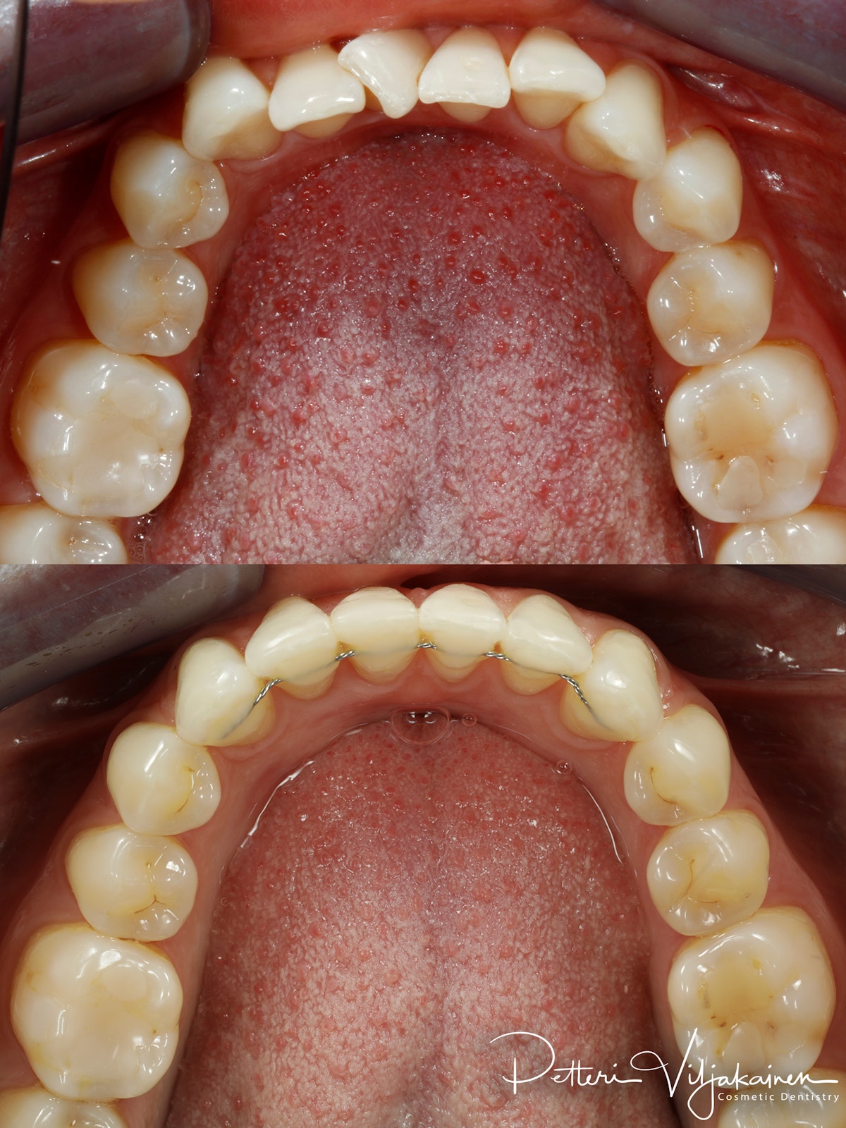 Invisalign oikomishoito ennen/jälkeen.