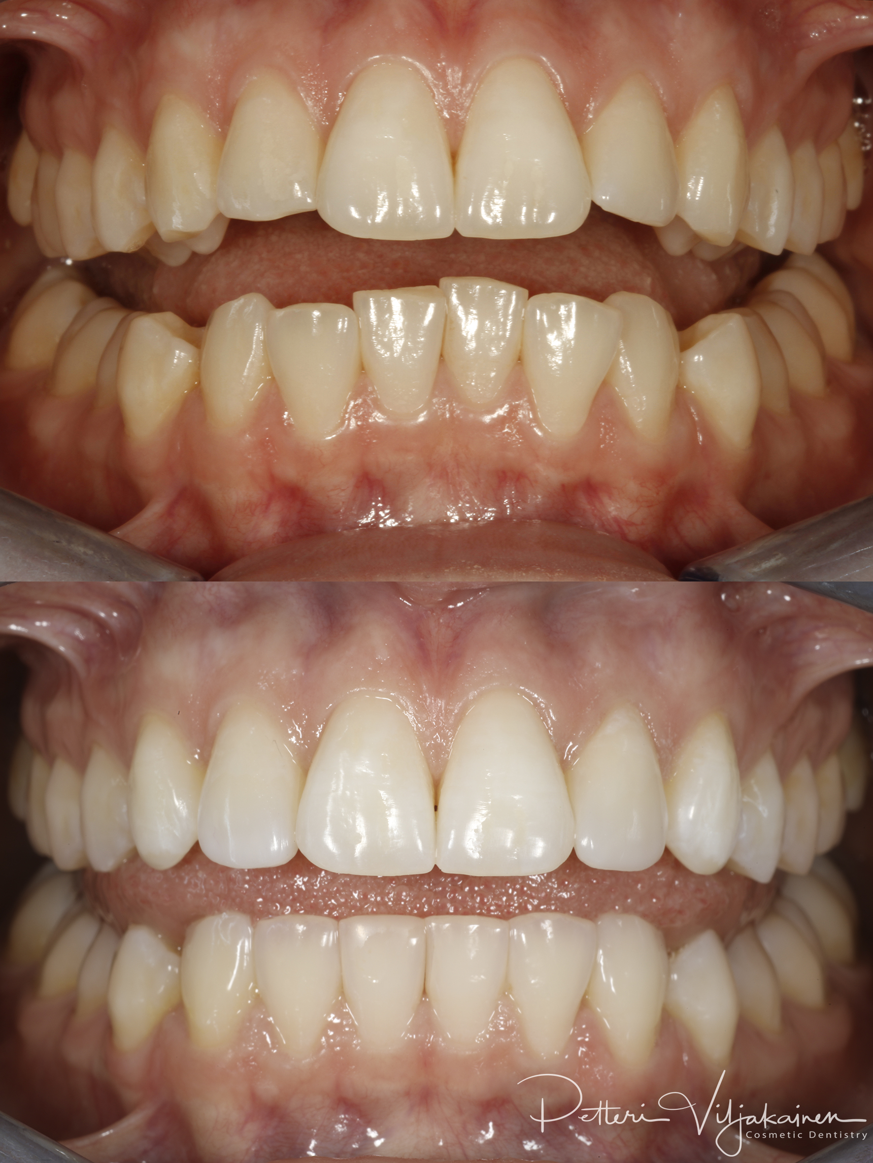 Invisalign oikomishoito ennen/jälkeen.