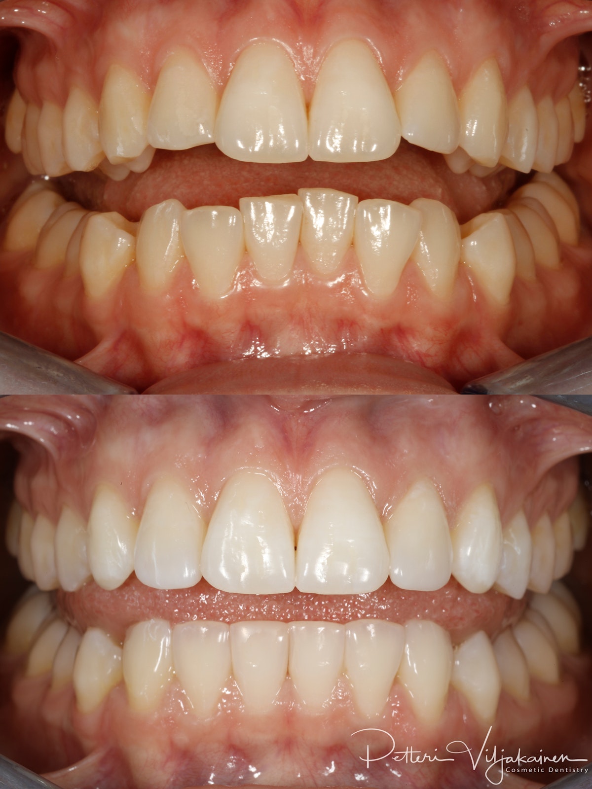 Invisalign oikomishoito ennen/jälkeen.