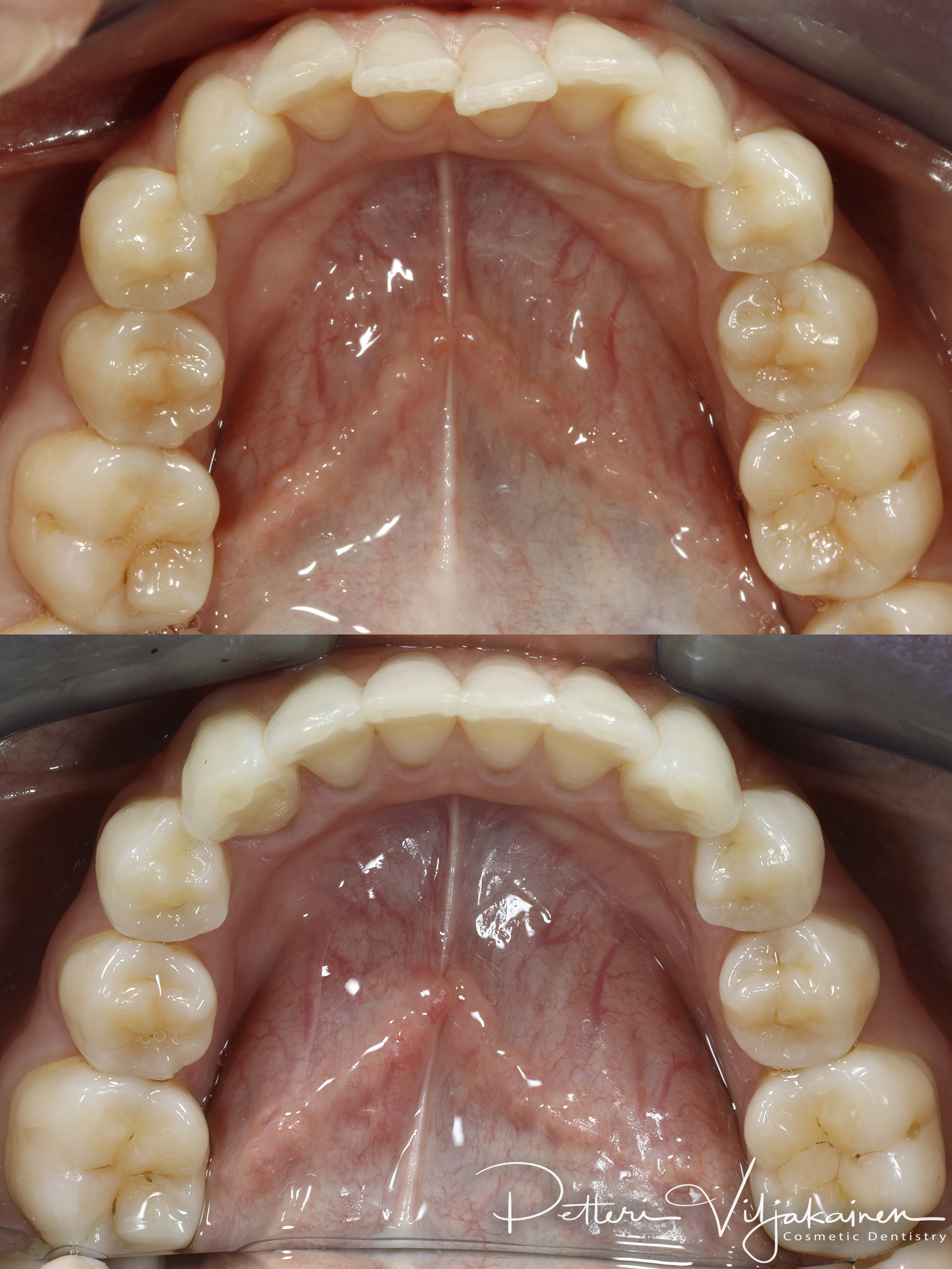 Invisalign oikomishoito ennen/jälkeen.
