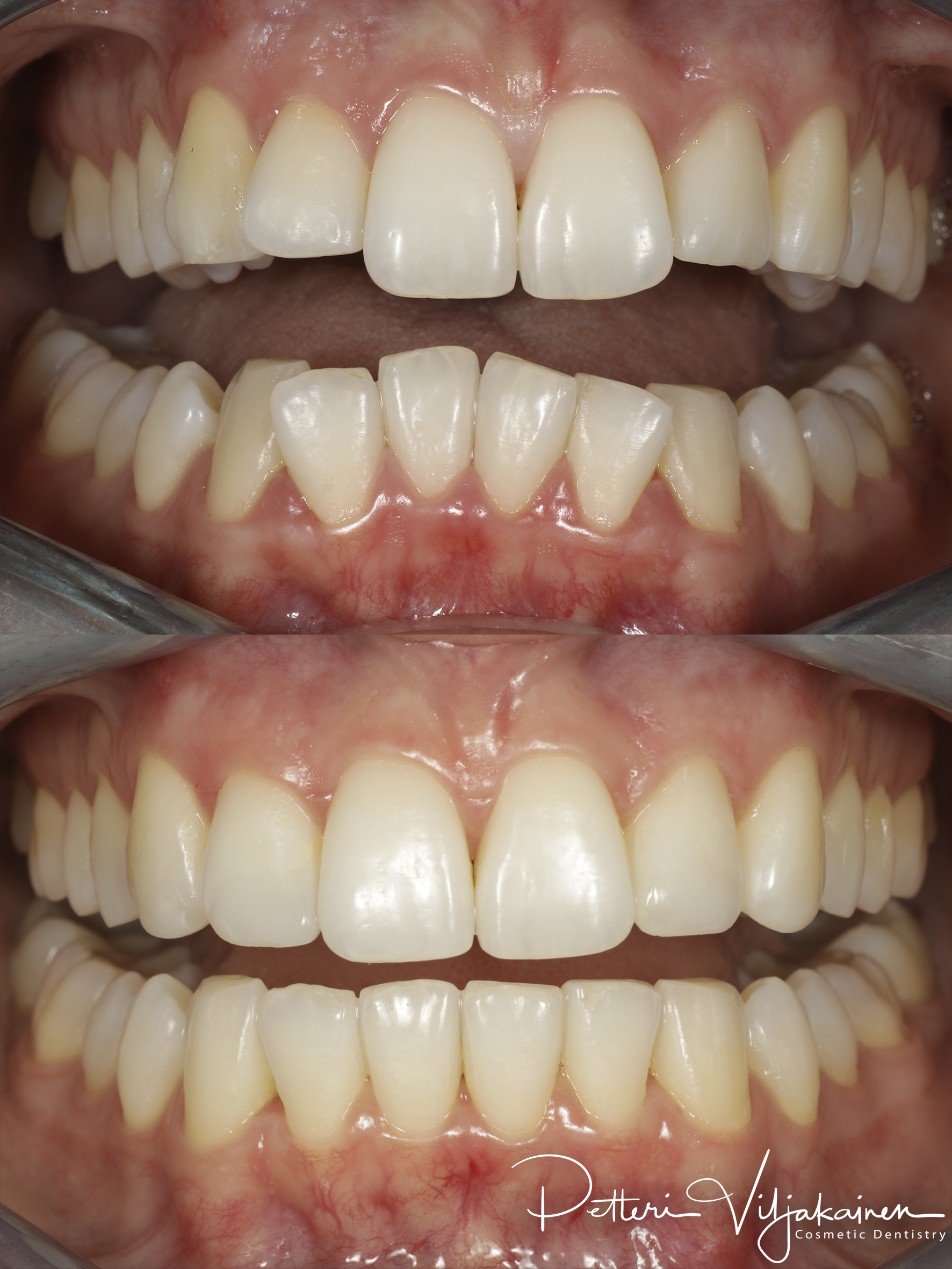 Oikomishoito ennen/jälkeen.