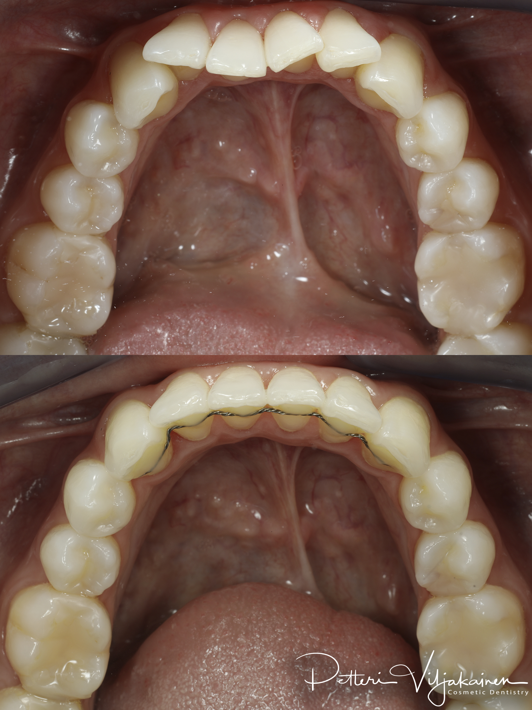 Oikomishoito ennen/jälkeen.