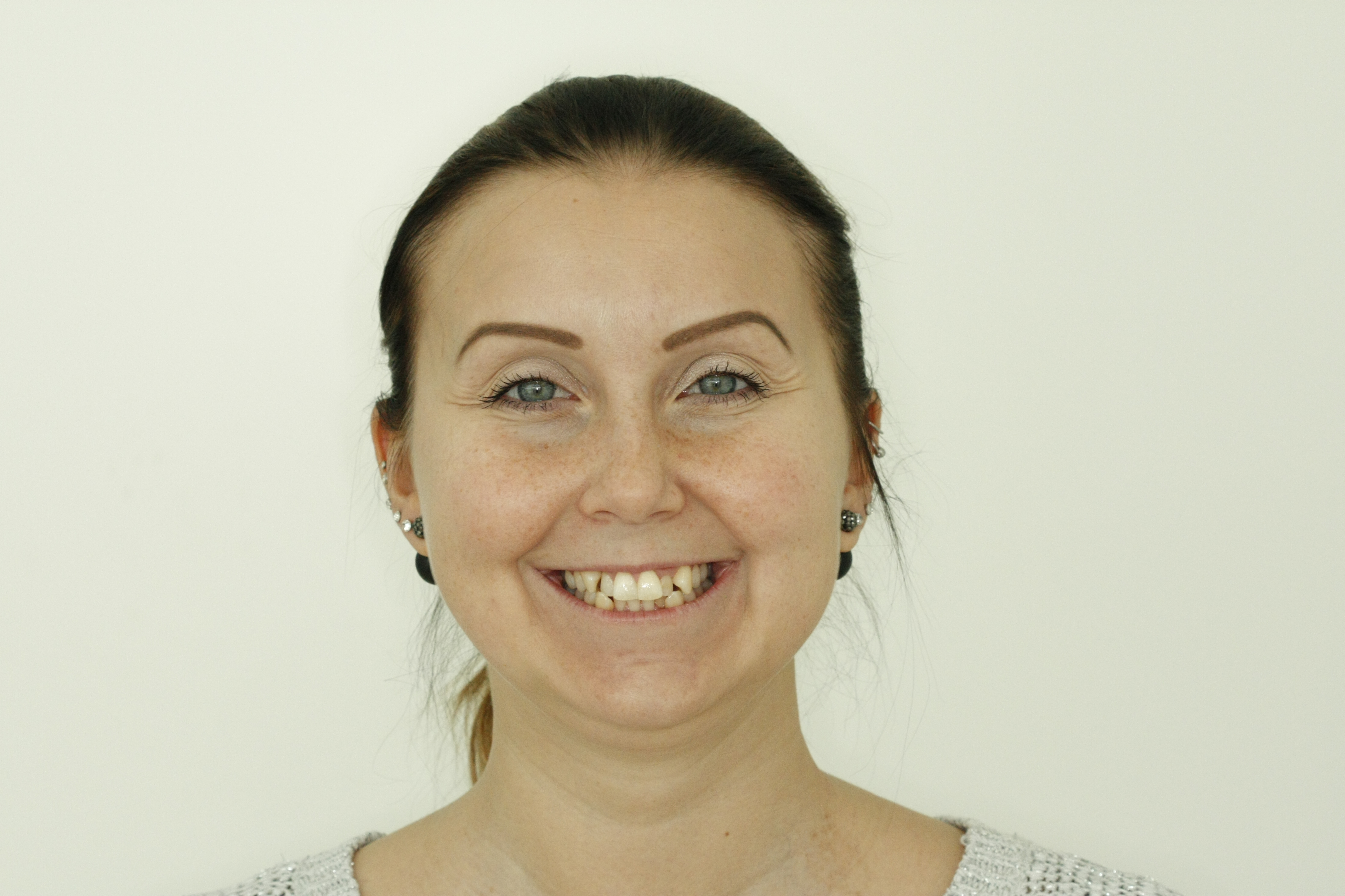 Invisalign oikomishoito. Ennen. 