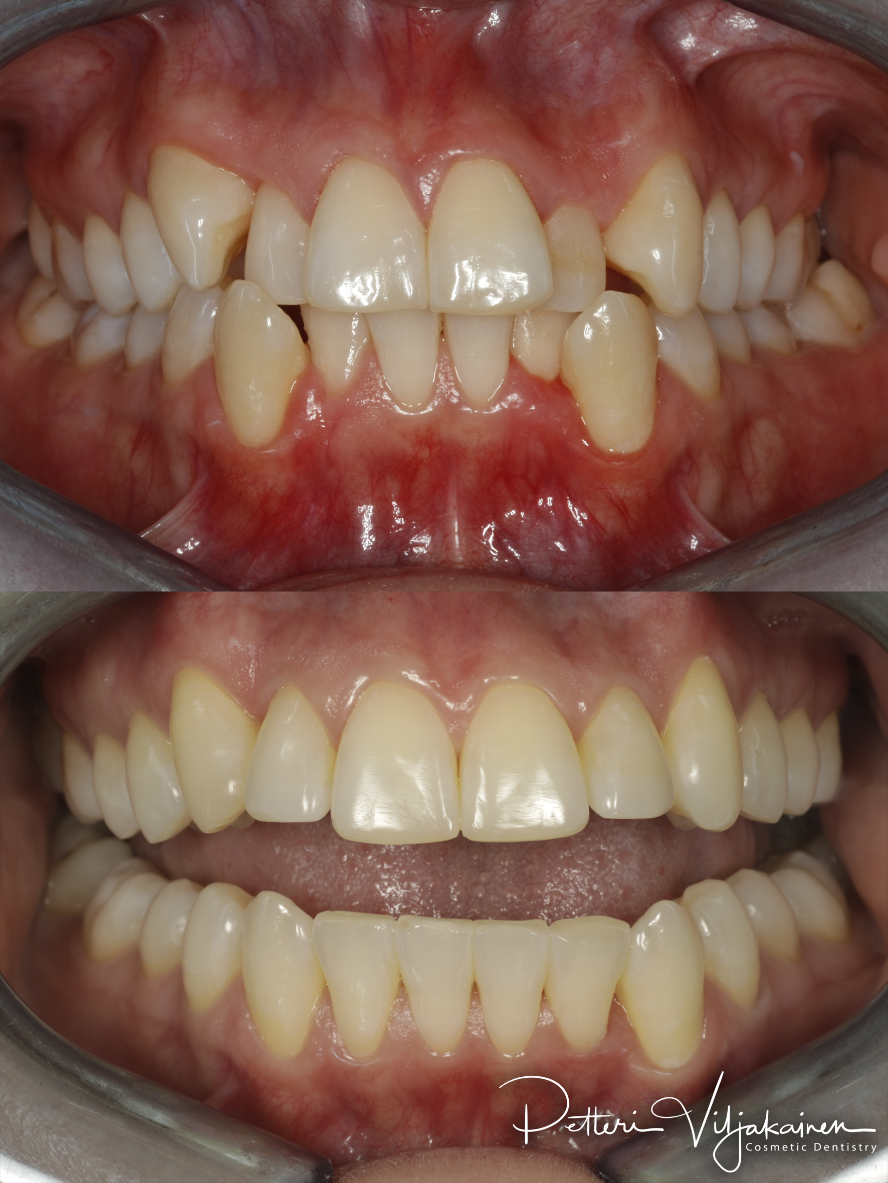 invisalign oikomishoito hampaat ennen jälkeen