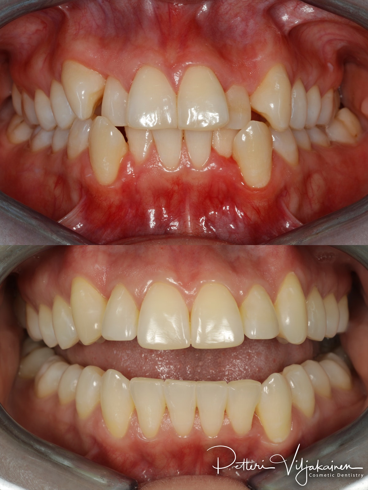 invisalign oikomishoito hampaat ennen jälkeen