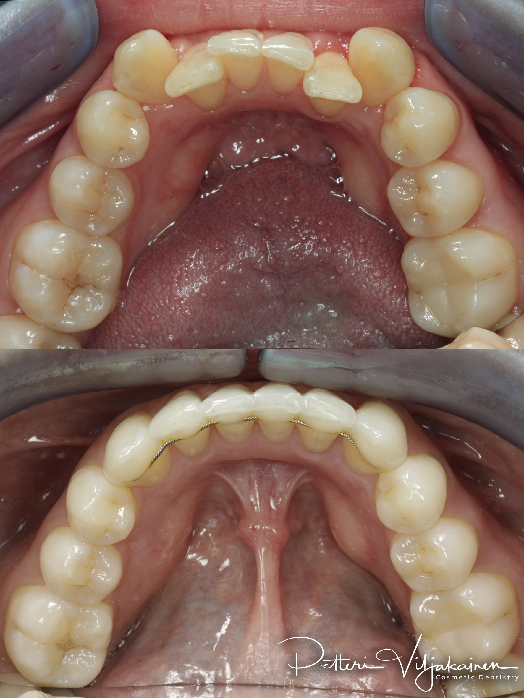 invisalign oikomishoito hampaat ennen jälkeen retentiolanka