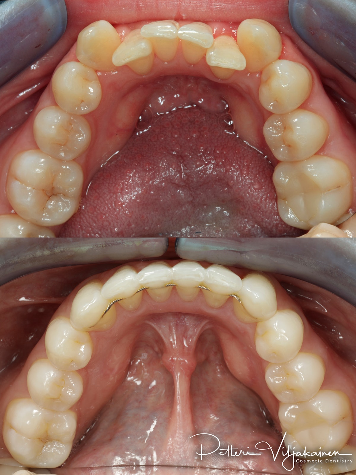 invisalign oikomishoito hampaat ennen jälkeen retentiolanka