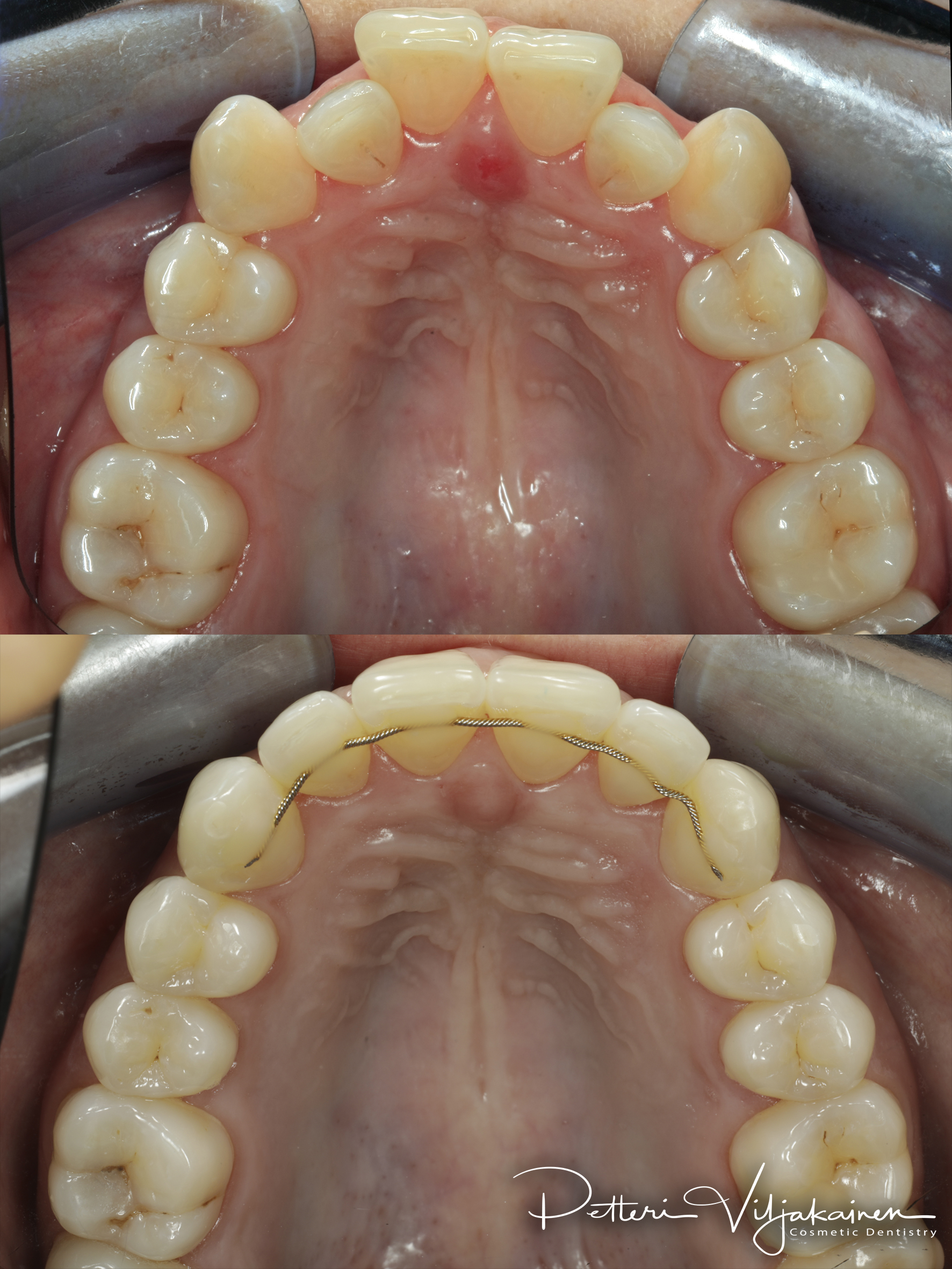 invisalign oikomishoito hampaat ennen jälkeen retentiolanka