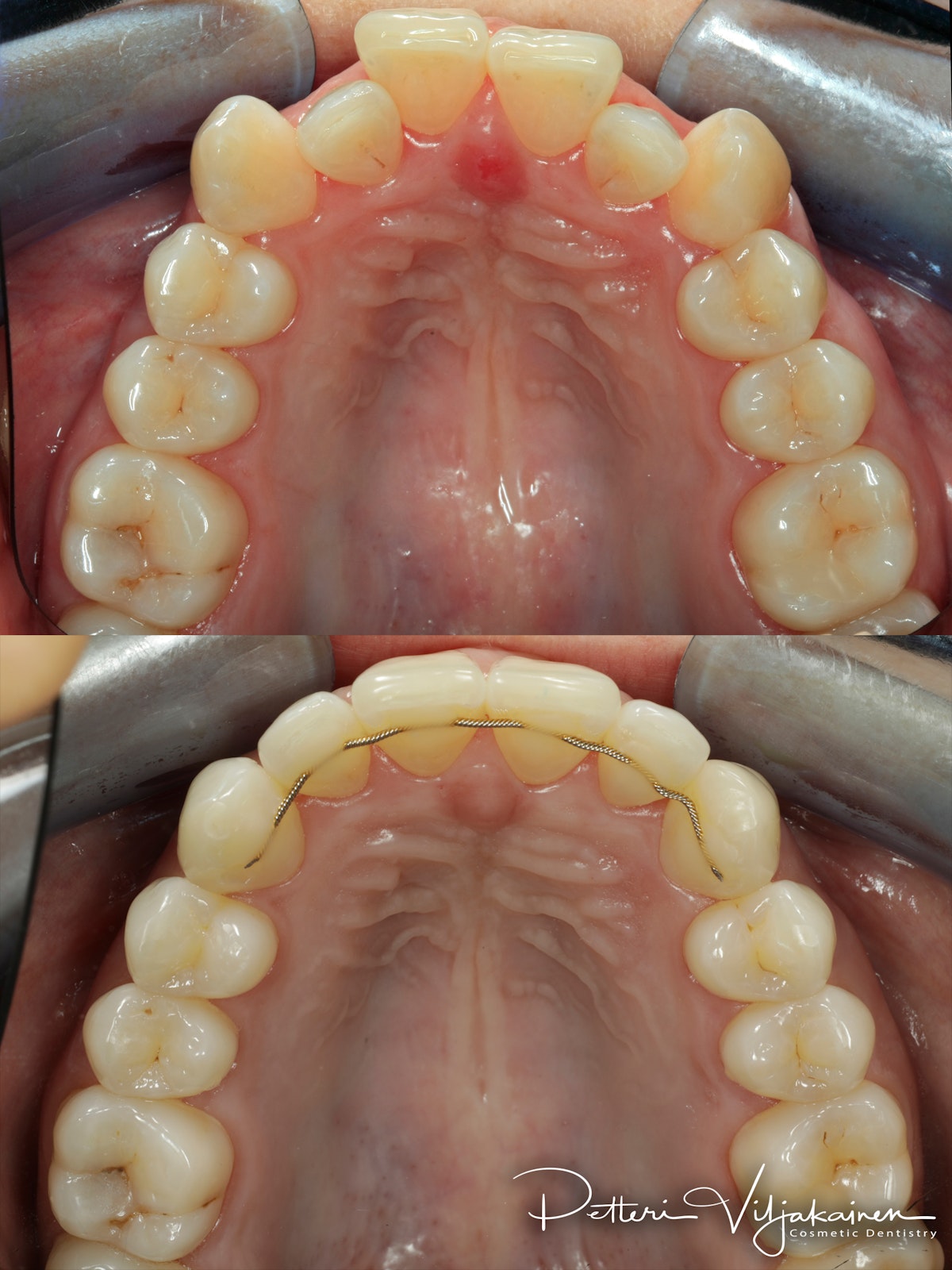 invisalign oikomishoito hampaat ennen jälkeen retentiolanka