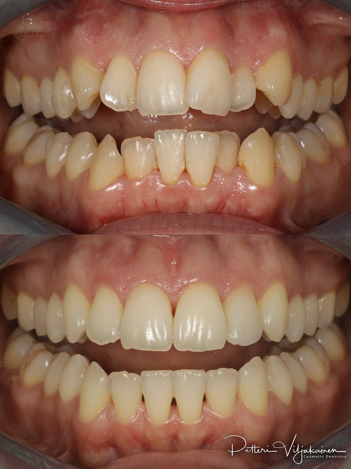 invisalign oikomishoito hampaat ennen jälkeen keraaminen kuori AACD accrediation JCD