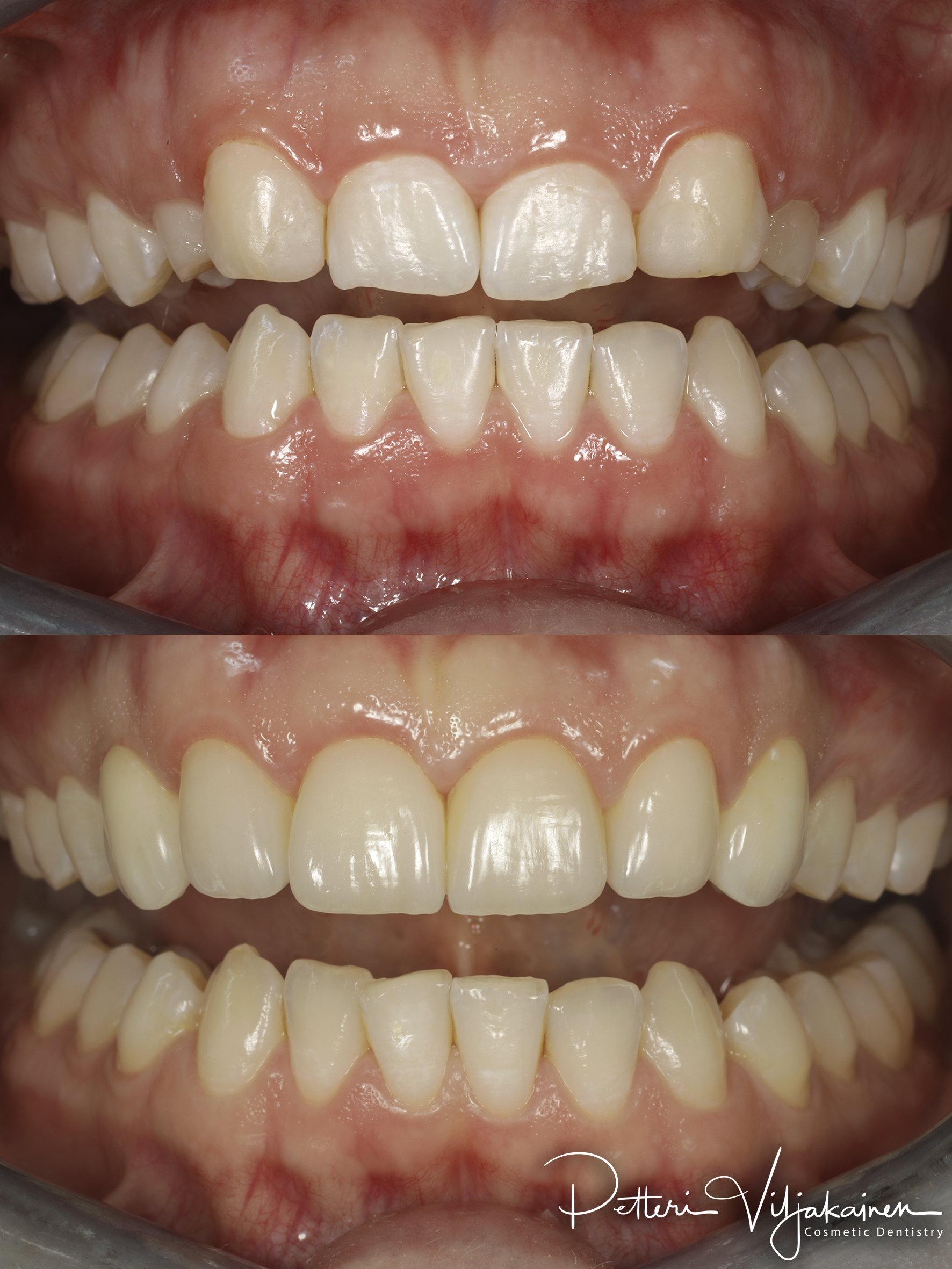 invisalign oikomishoito hampaat ennen jälkeen implanttikruunut keraamiset kuoret