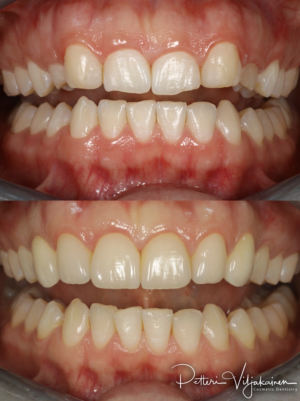 invisalign oikomishoito hampaat ennen jälkeen implanttikruunut keraamiset kuoret