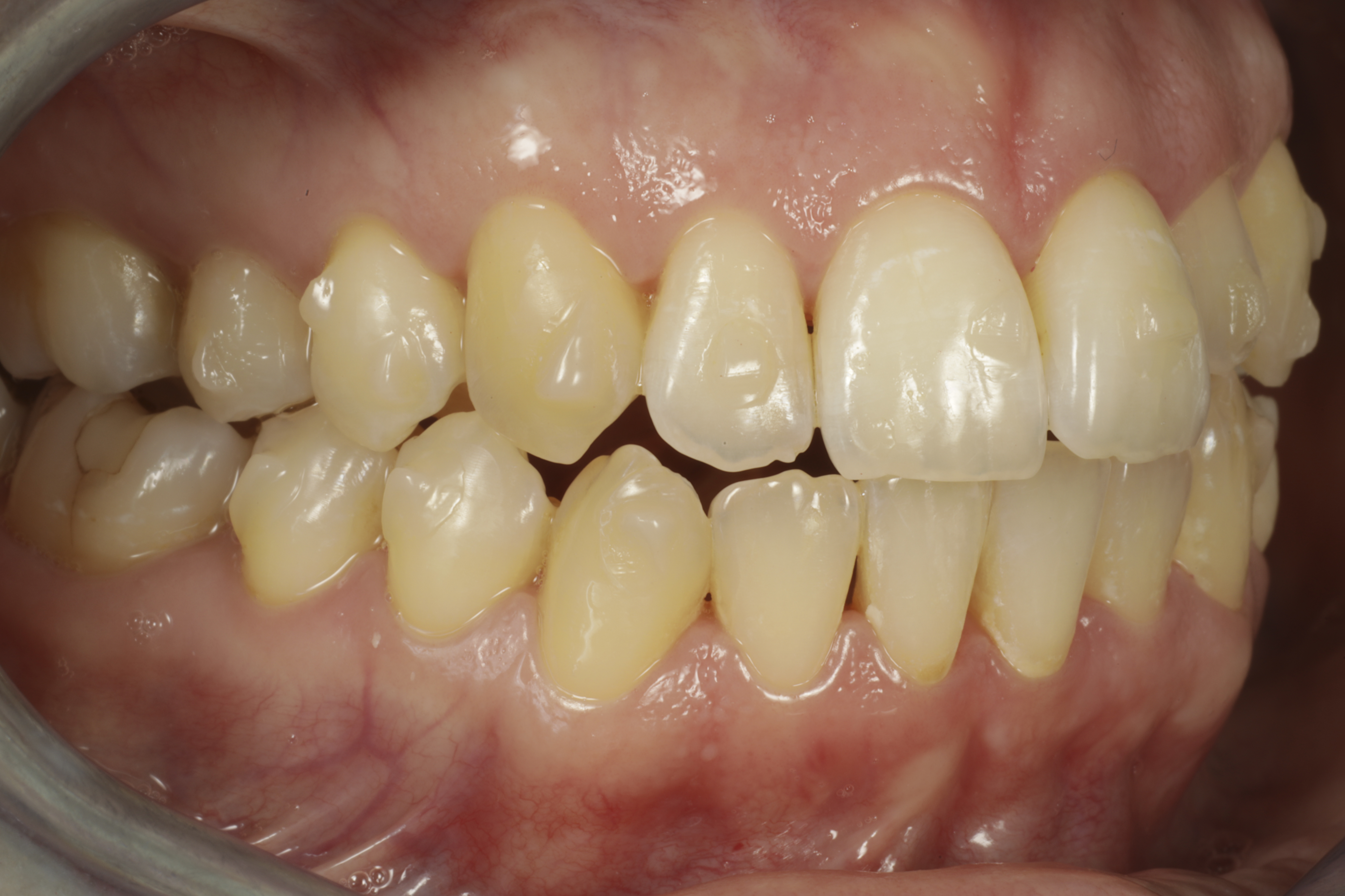 invisalign oikomishoito kiinnikkeet hampaissa