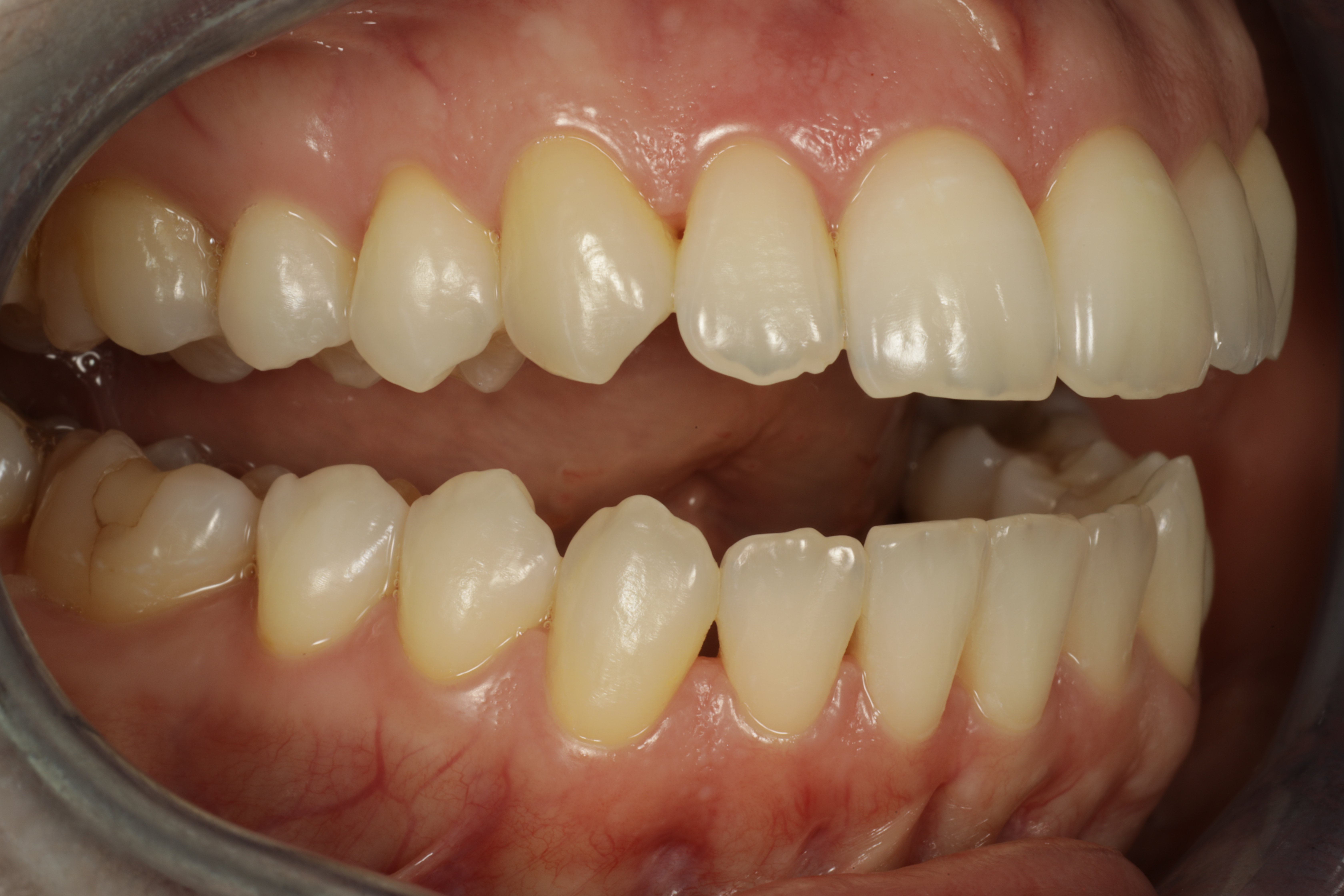 invisalign oikomishoito lopputilanne