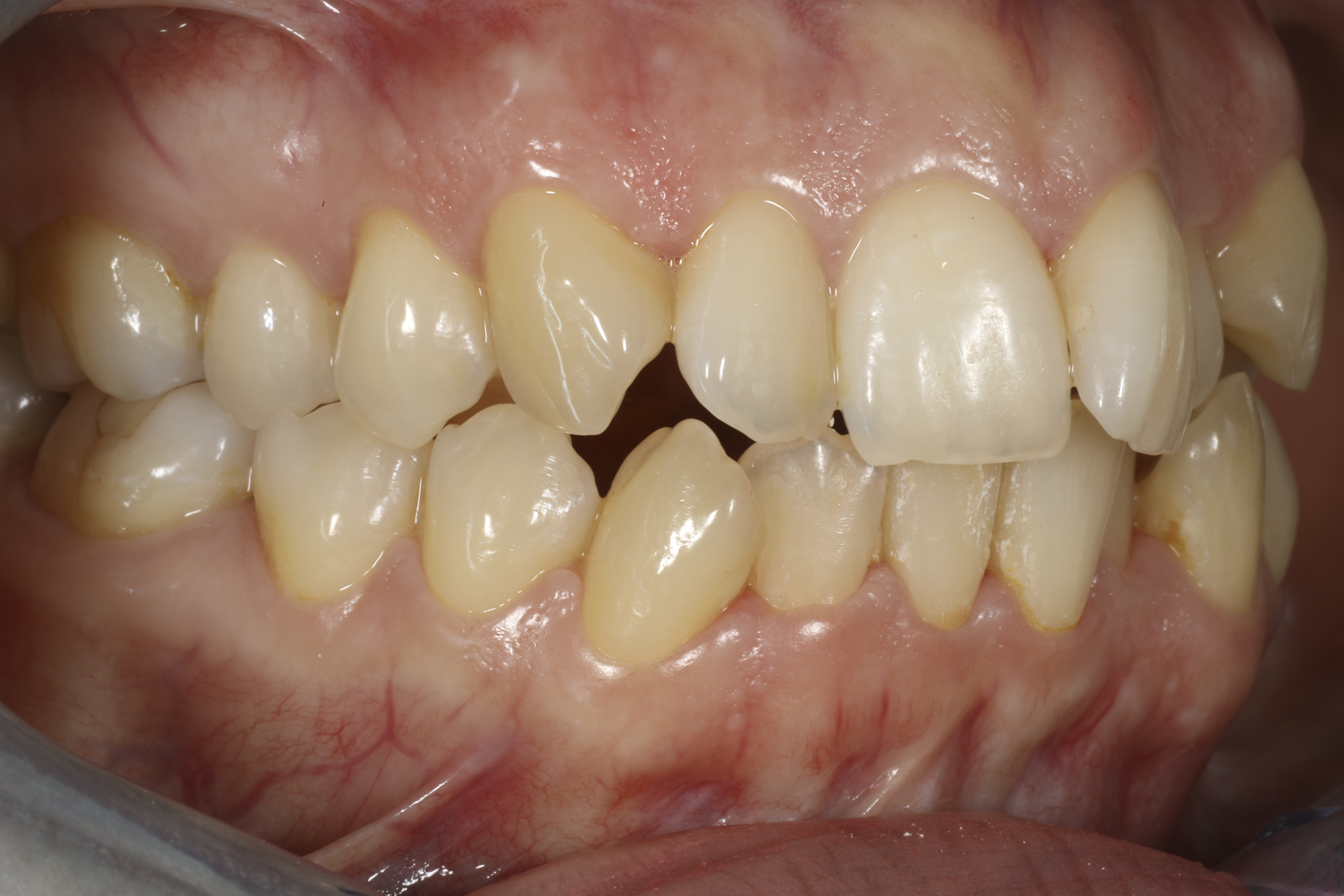 invisalign oikomishoito hampaat ennen kiinnikkeitä