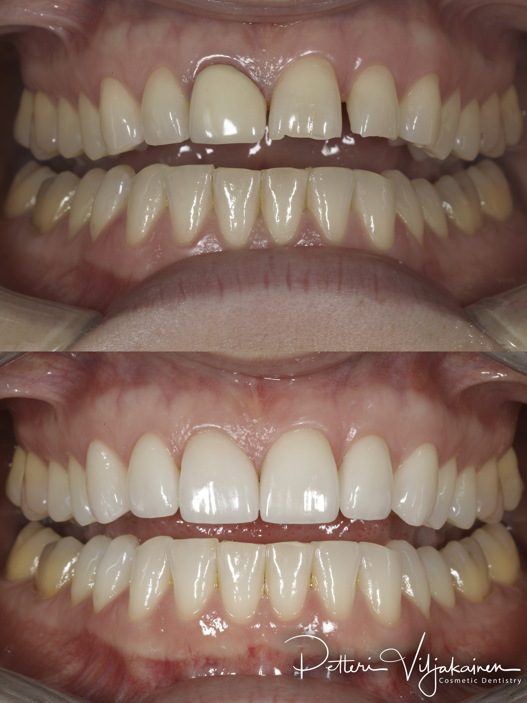 Esteettinen hammashoito ennen jälkeen. Keraamiset kuoret eli hammaslaminaatit kuudessa yläetuhampaassa.